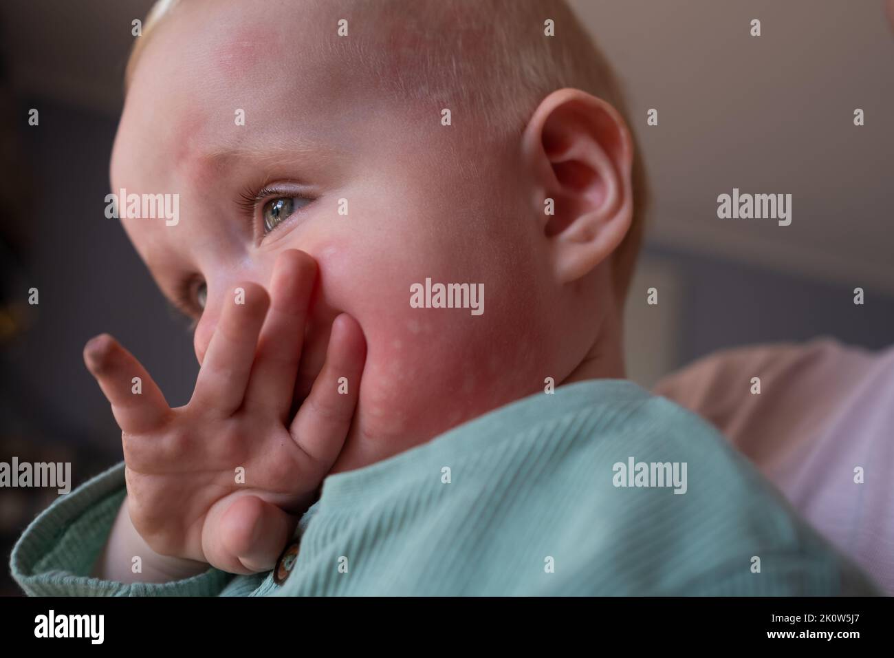 Brennnessel Hautausschlag Allergie auf Gesicht in einem Kleinkind Gesicht. Stockfoto
