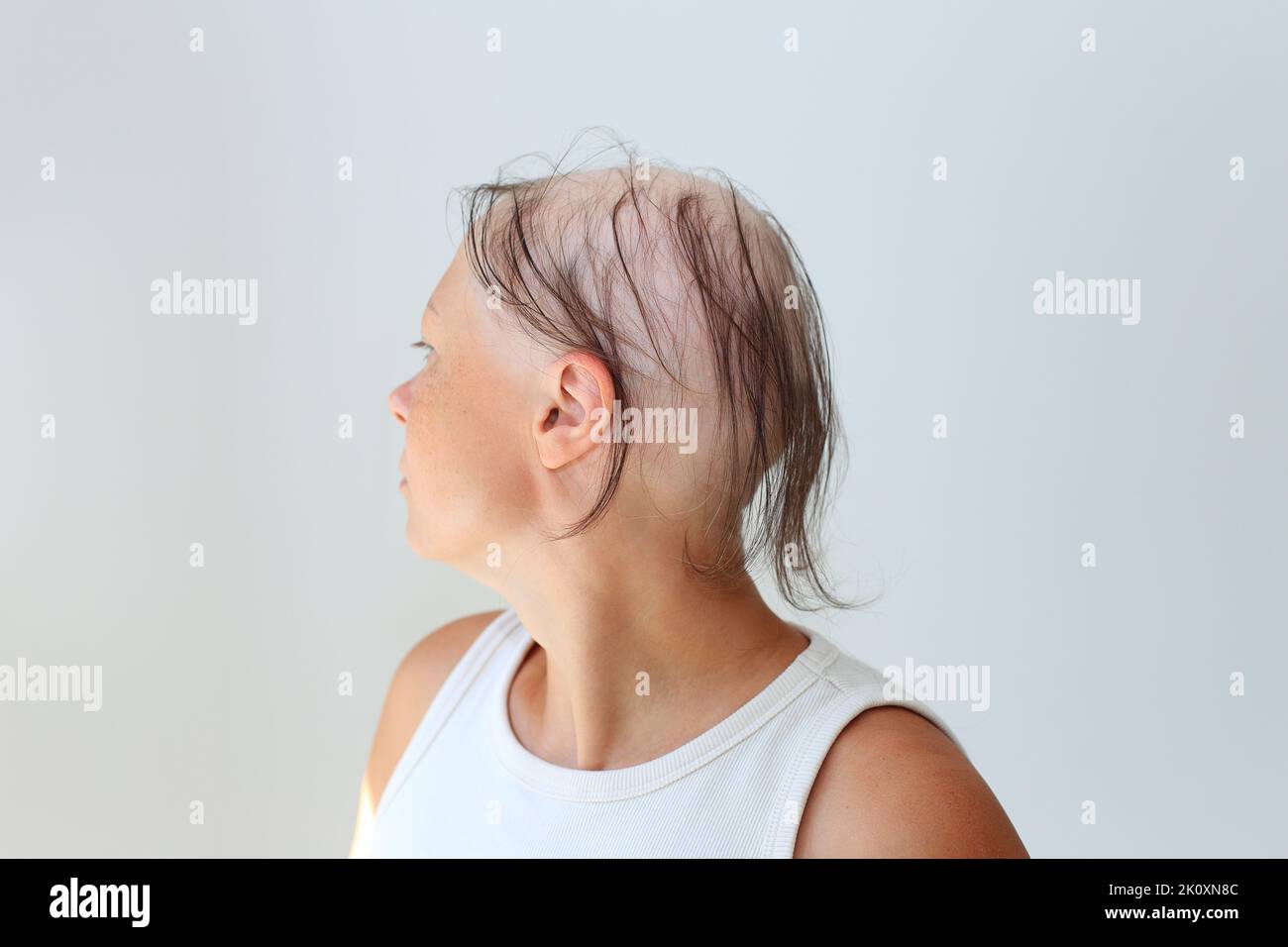 Haarausfall in Form von Alopecia areata. Kahlköpfiger Kopf einer Frau. Haarausfall nach Covid