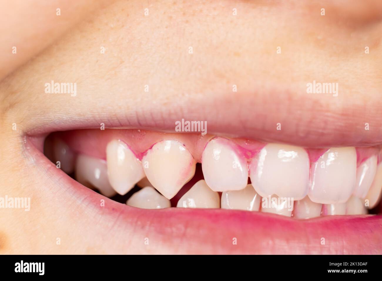 Plaque auf menschlichen Zähnen ist rosa mit Indikatortabletten gefärbt. Stockfoto