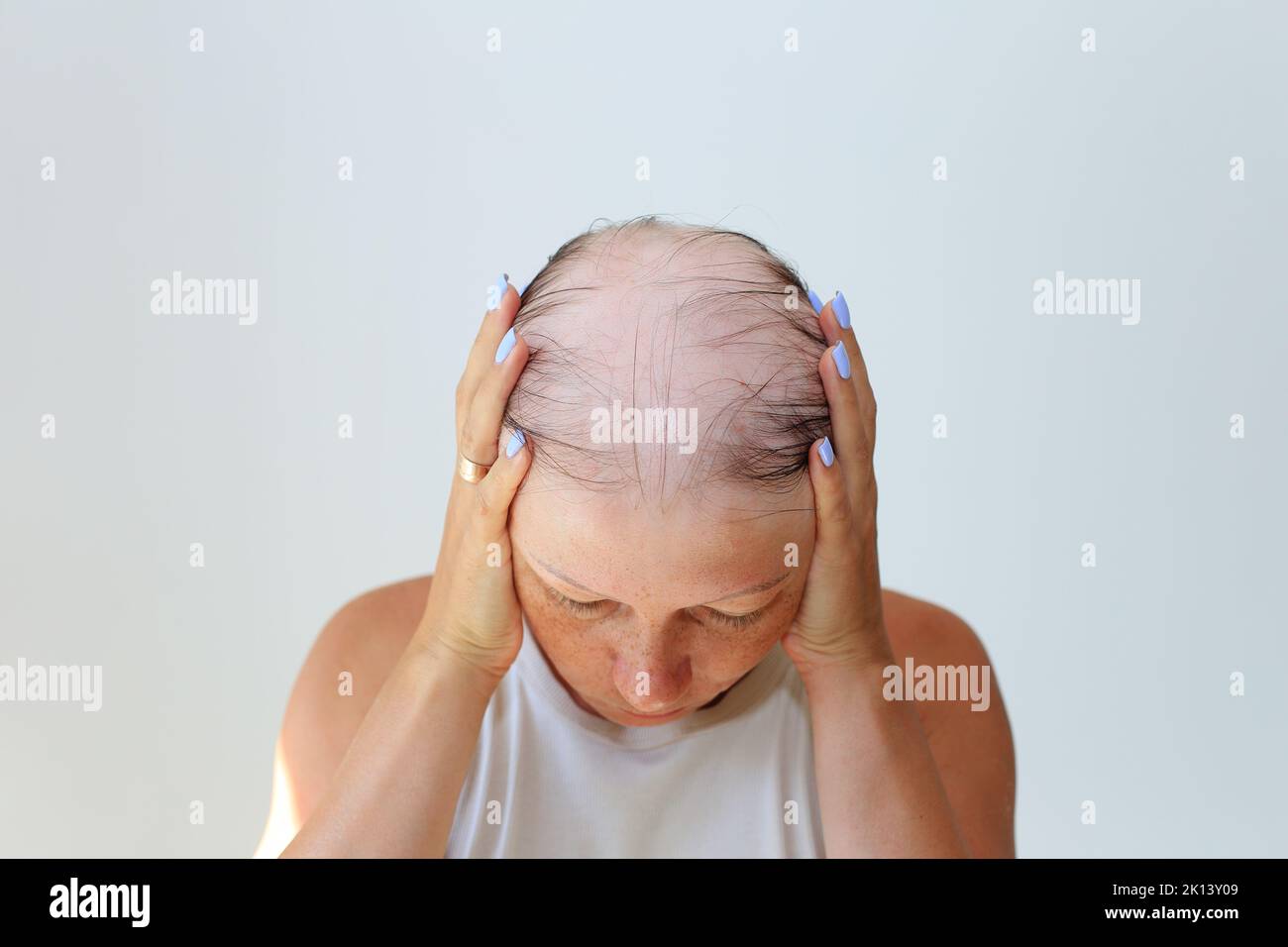 Haarausfall in Form von Alopecia areata. Kahlköpfiger Kopf einer Frau ...