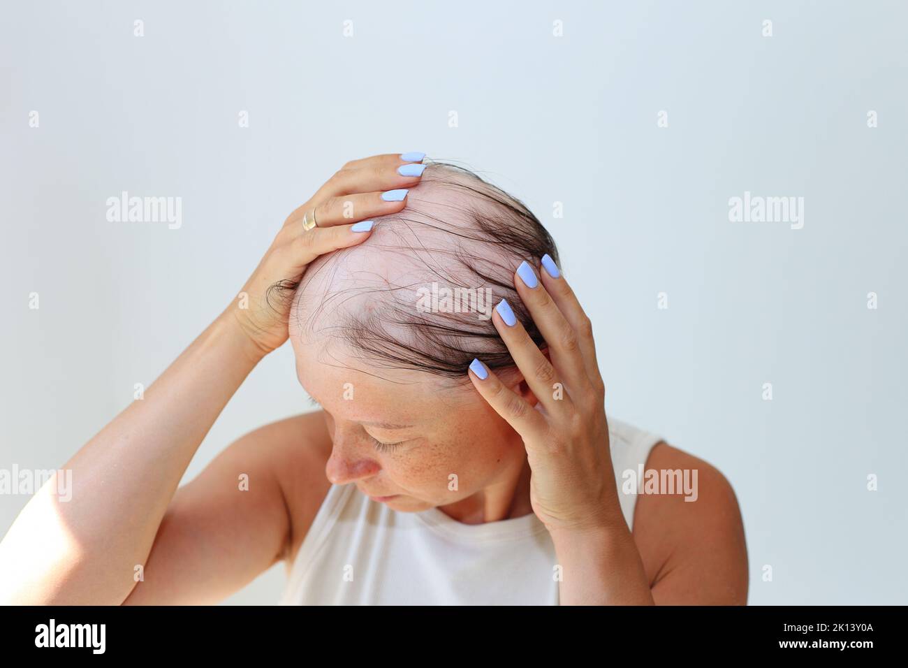 Haarausfall in Form von Alopecia areata. Kahlköpfiger Kopf einer Frau. Haarausfall nach Covid. Kahle Stellen mit totaler Alopezie Stockfoto