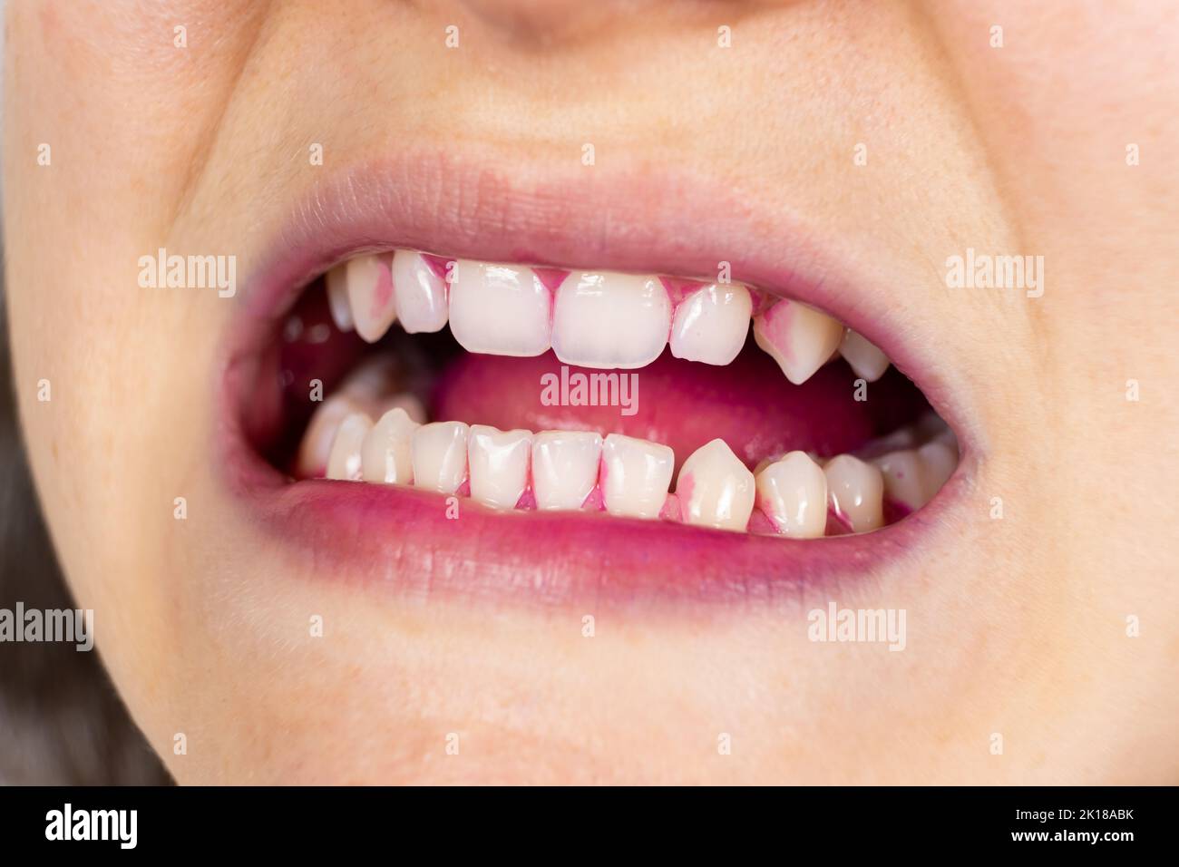 Plaque auf menschlichen Zähnen ist rosa mit Indikatortabletten gefärbt. Stockfoto