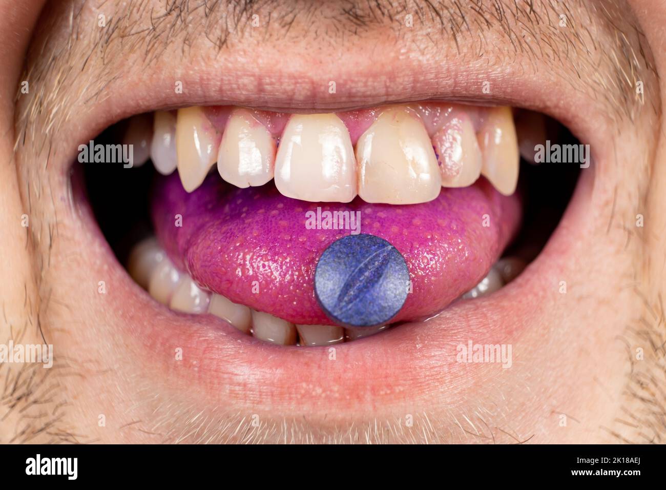 Eine Person zeigt eine Indikatorpille auf seiner Zunge, um Plaque zu bestimmen. Stockfoto