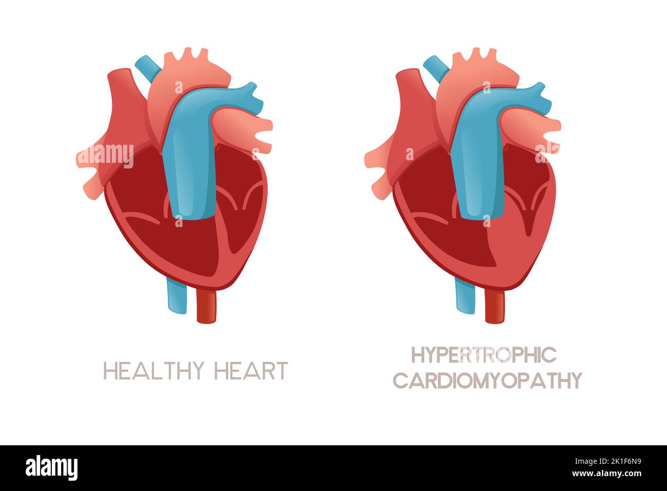 Gesundes menschliches Herz und Herz mit hypertropher Kardiomyopathie Krankheit Anatomie Illustration Gesundheit Problem Vektor Illustration auf weißem Hintergrund Stock Vektor