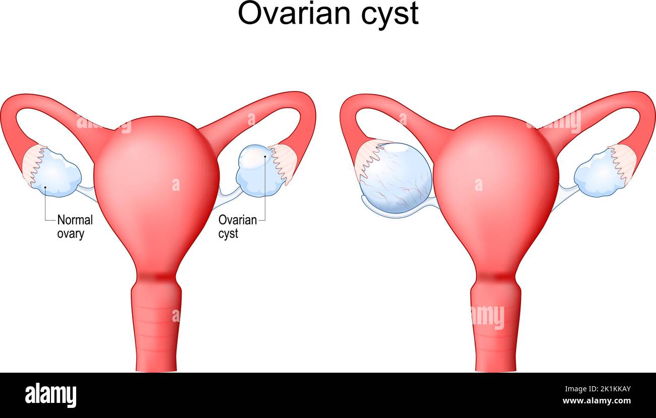 Eierstockzyste. Menschlicher Uterus mit flüssigkeitsgefülltem Beutel im Eierstock. Weibliches Fortpflanzungssystem. Vektorgrafik Stock Vektor