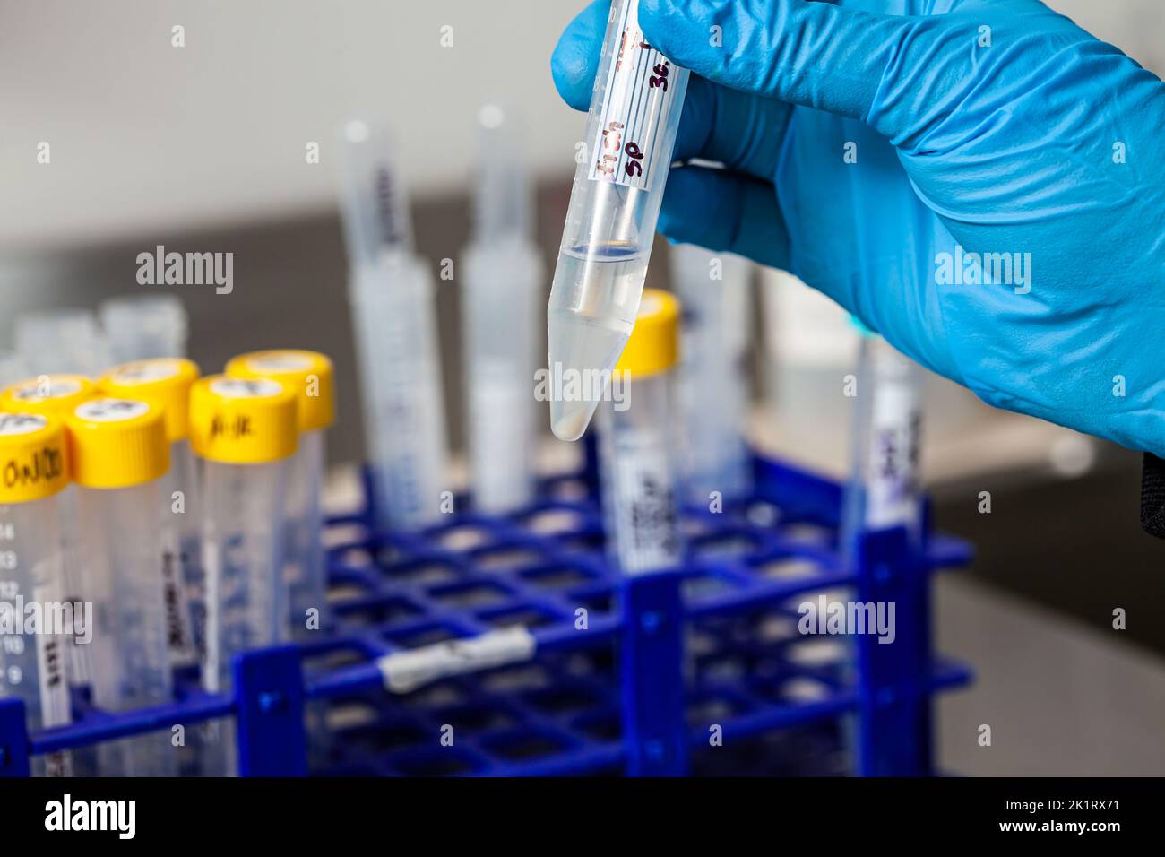 Reagenzglas mit Blutkörperchen, das nach mehreren Wäschen und Zentrifugation gewonnen wurde. Stockfoto
