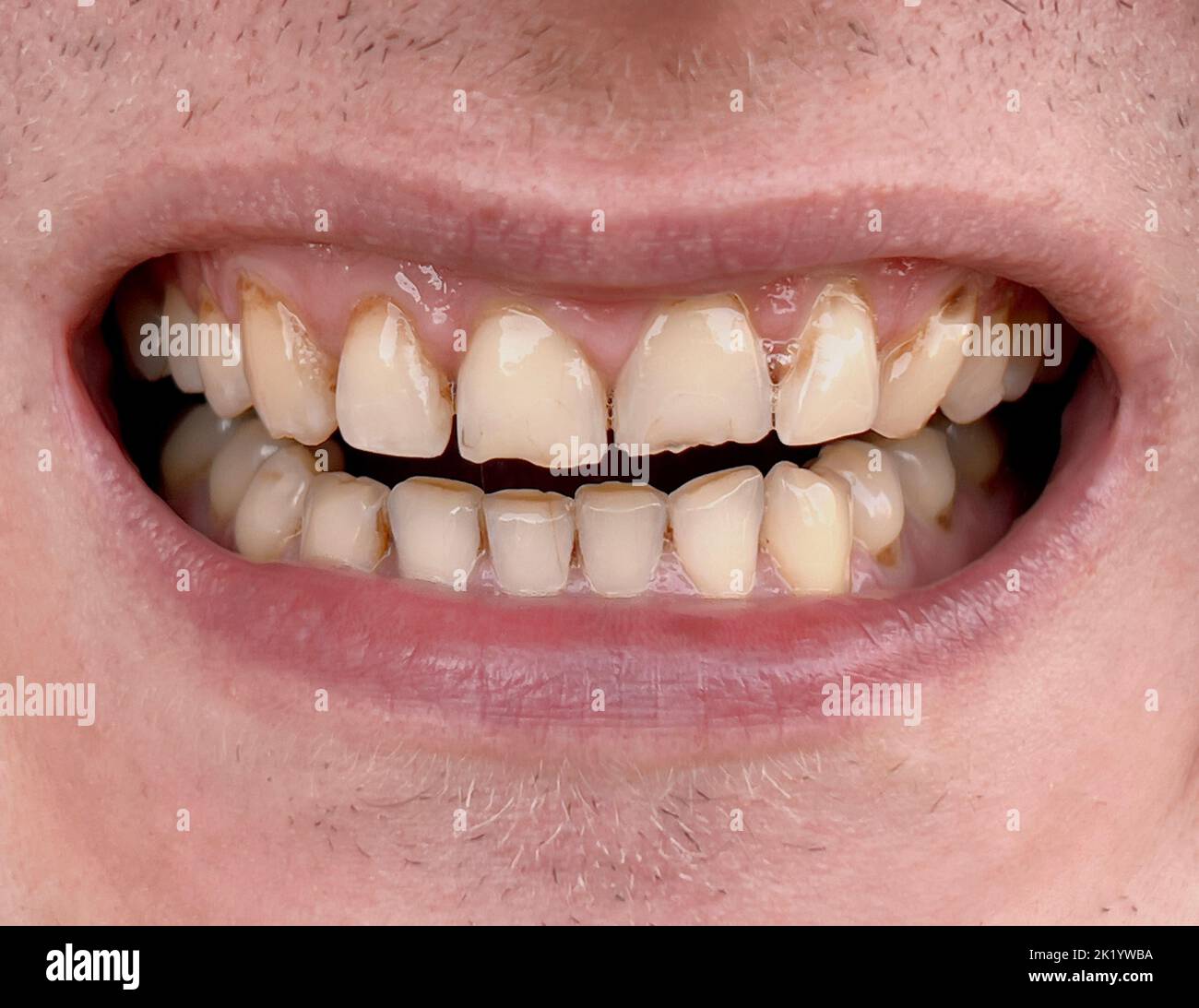 Lächelnder Mund eines Mannes mit schiefen gelben Zähnen aus der Nähe. Ungesunde abgenutzte Zähne, die in der Zahnmedizin behandelt werden müssen. Bruxismus Stockfoto