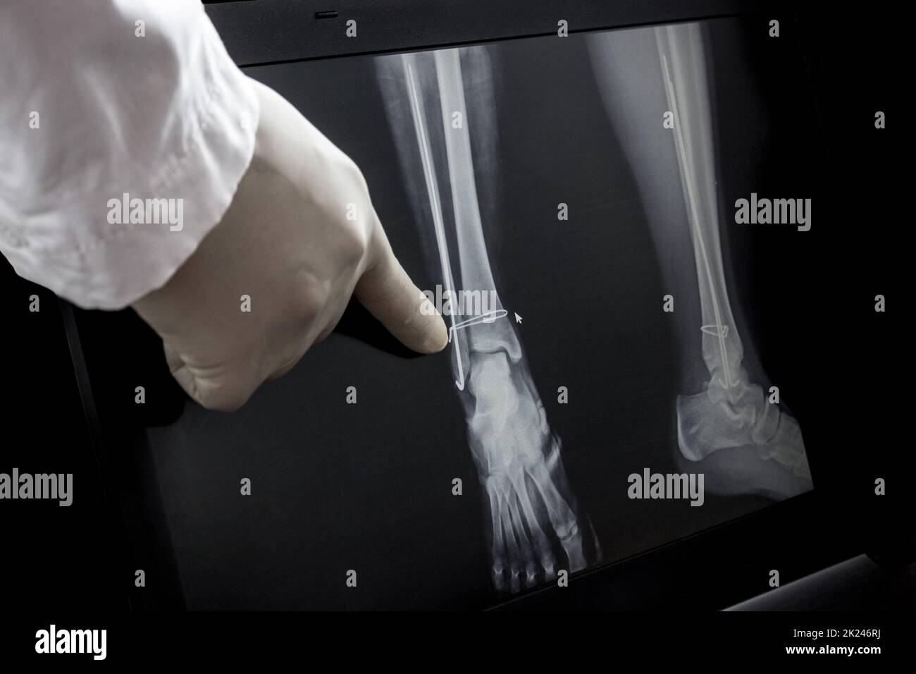 Röntgenaufnahme des Beins nach der Operation - Drähte im Bein. Der Arzt zeigt mit dem Finger auf den operierten Bereich. Stockfoto