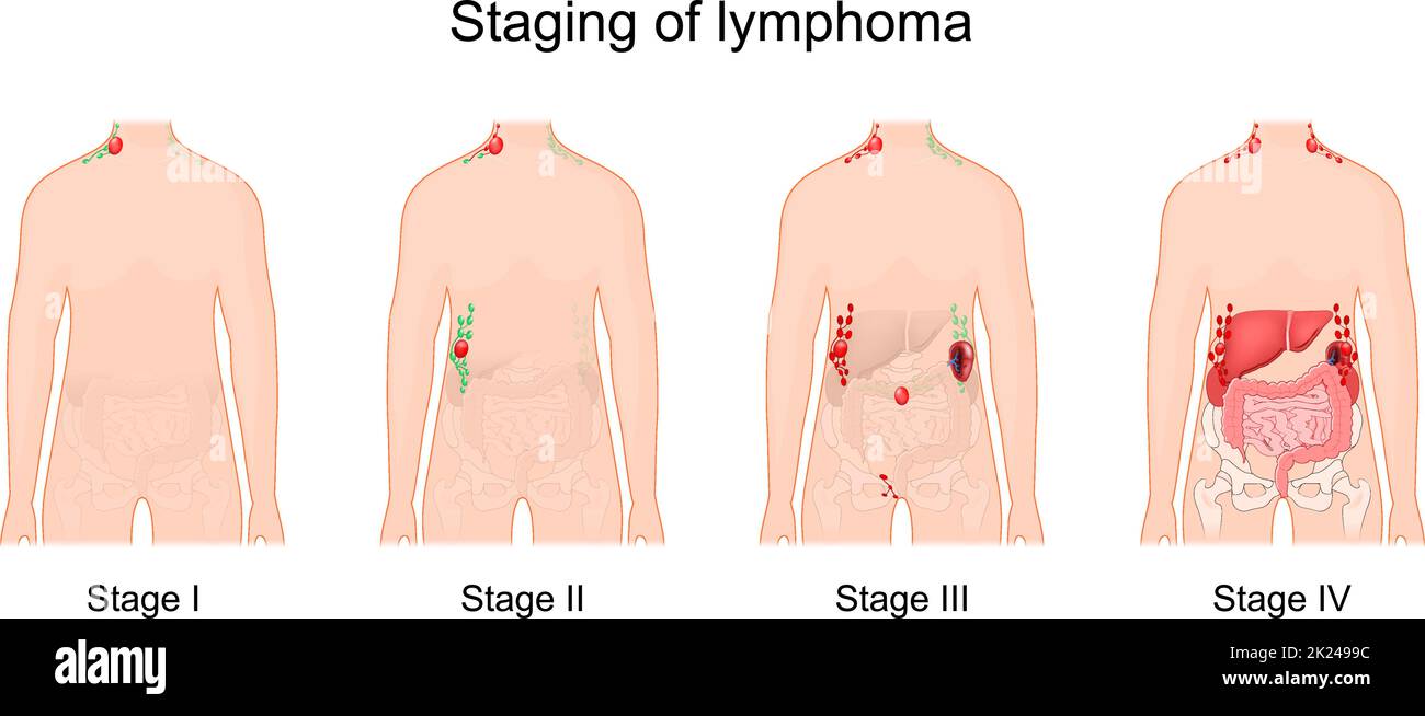Stadium eines Lymphoms. Krebs des Lymphsystems. Anzeichen und Symptome Krankheit. Menschliche Silhouette mit normalen und vergrößerten Lymphknoten Stock Vektor