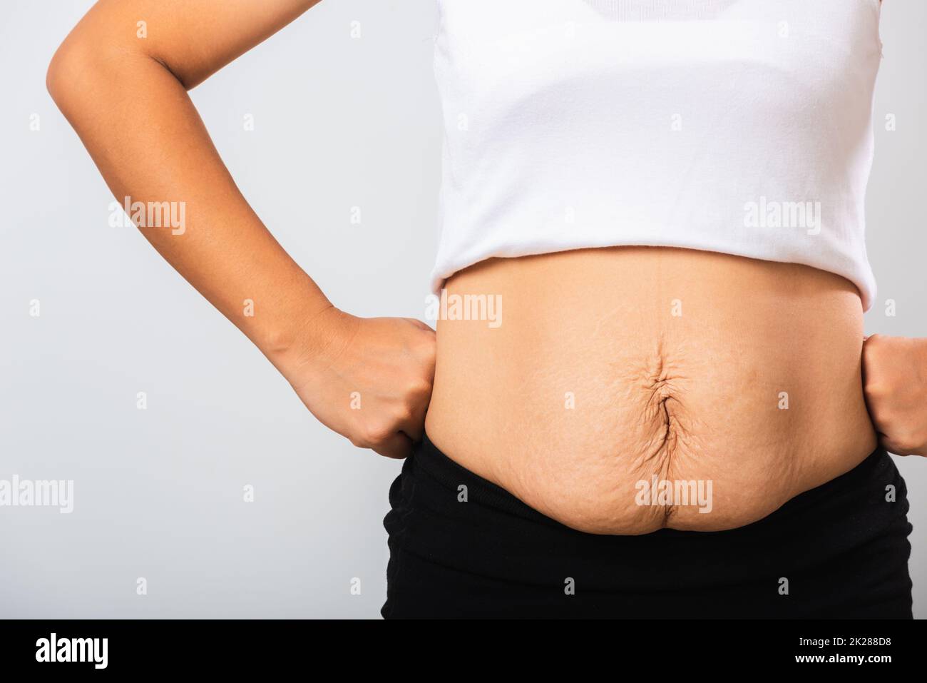 Frau mit Dehnungsstreifen lockere Unterbauchhaut, die nach der Schwangerschaft fett ist Stockfoto