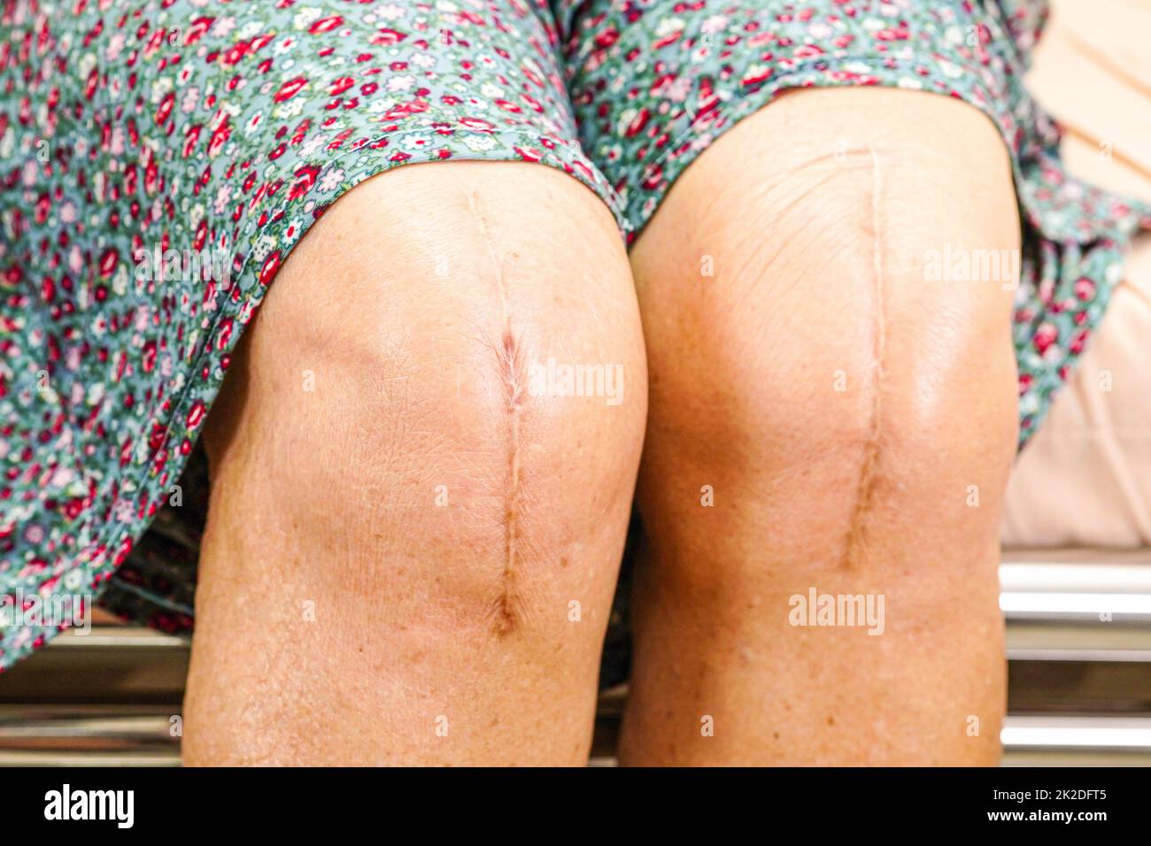 Asiatische ältere Frau Patientin mit Narbenersatz Knie-Operation im Krankenhaus. Stockfoto