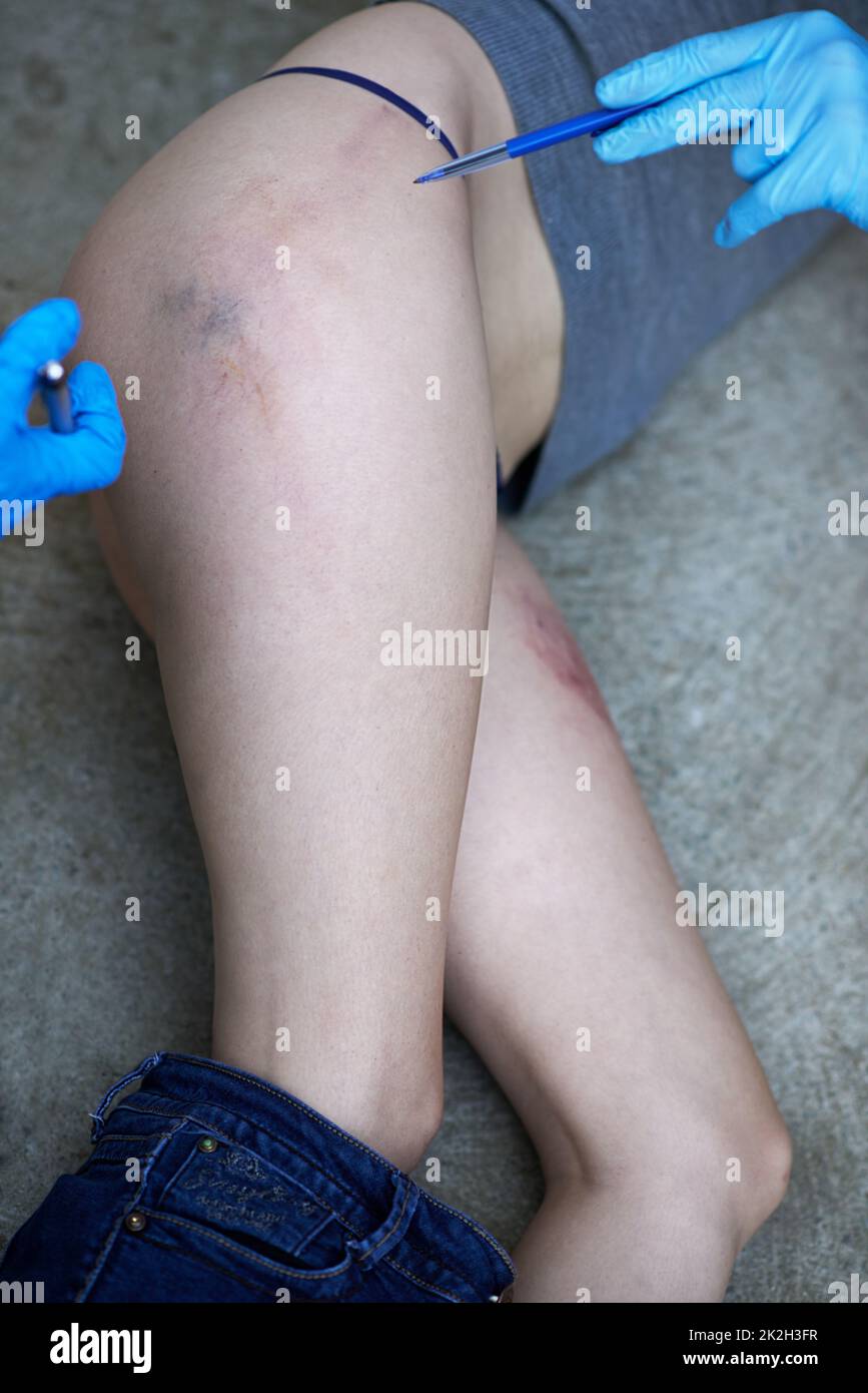Ein tragisches Ende aller Misshandlungen. Kurze Aufnahme einer Frau mit gequetschten Beinen und heruntergezogener Jeans. Stockfoto