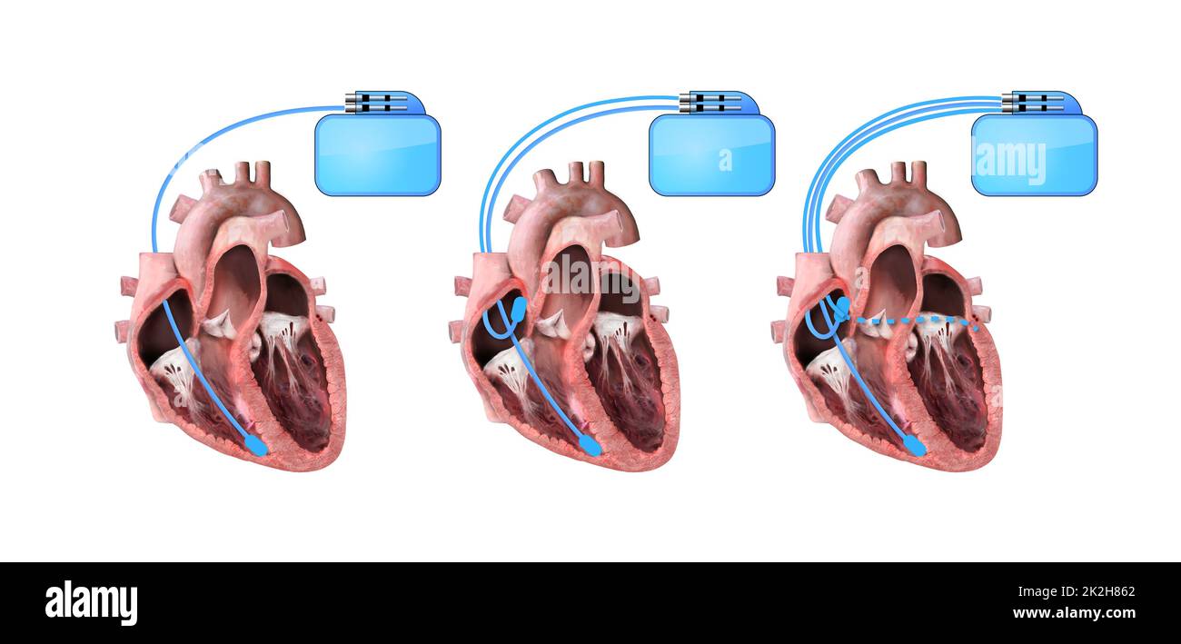 Herz und Herzschrittmacher auf weißem Hintergrund 3D-Rendering, Herzanatomie, Schnitt, rechter und linker Ventrikel, Vorhöfe, Klappen Stockfoto
