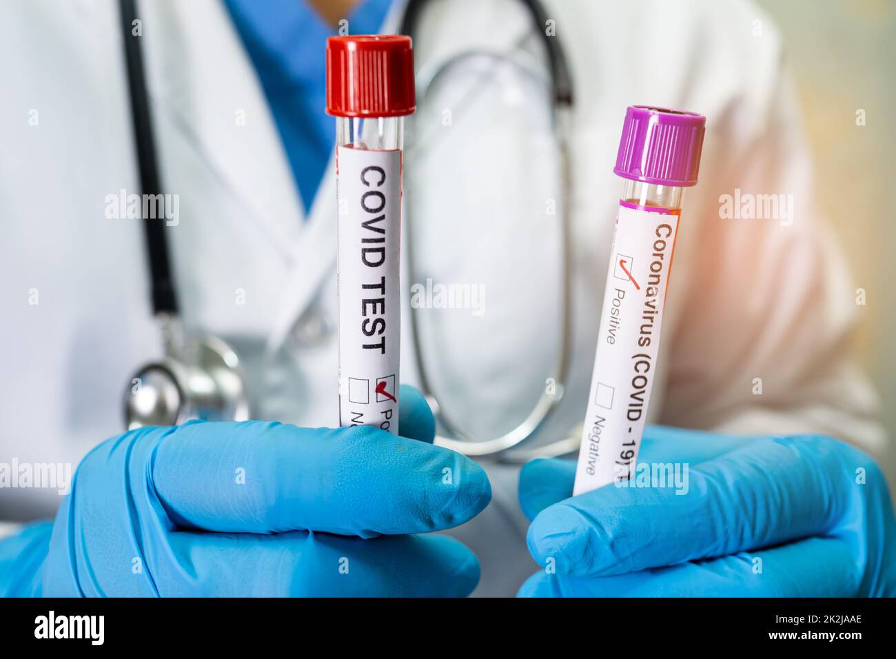 Positive Blutinfektionsprobe im Reagenzglas für omicron covid19-Coronavirus im Labor. Wissenschaftler hält an, um den Patienten im Krankenhaus zu überprüfen und zu analysieren. Stockfoto