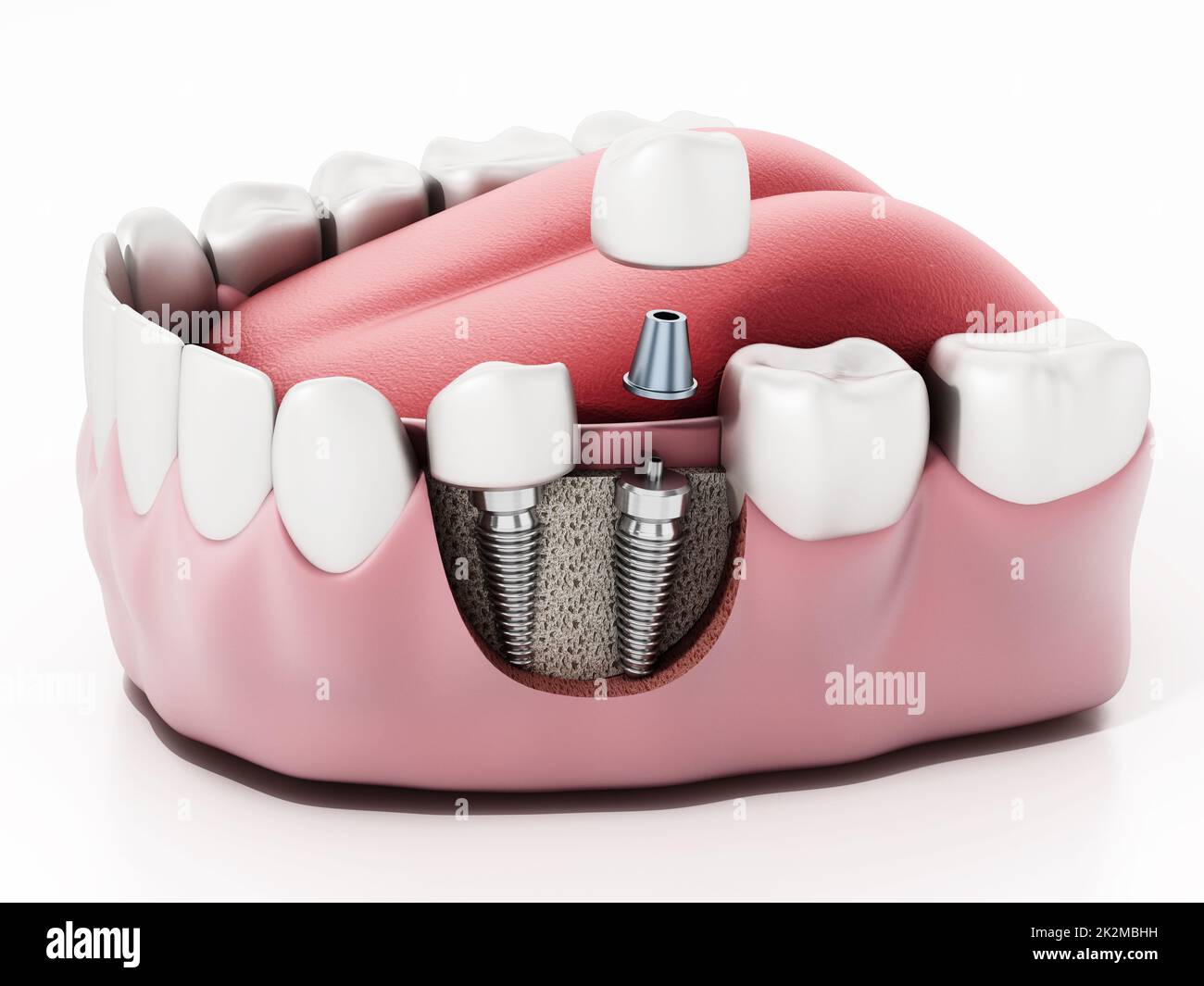 3D Darstellung von zwei Zahnimplantaten am Unterkiefer Stockfoto