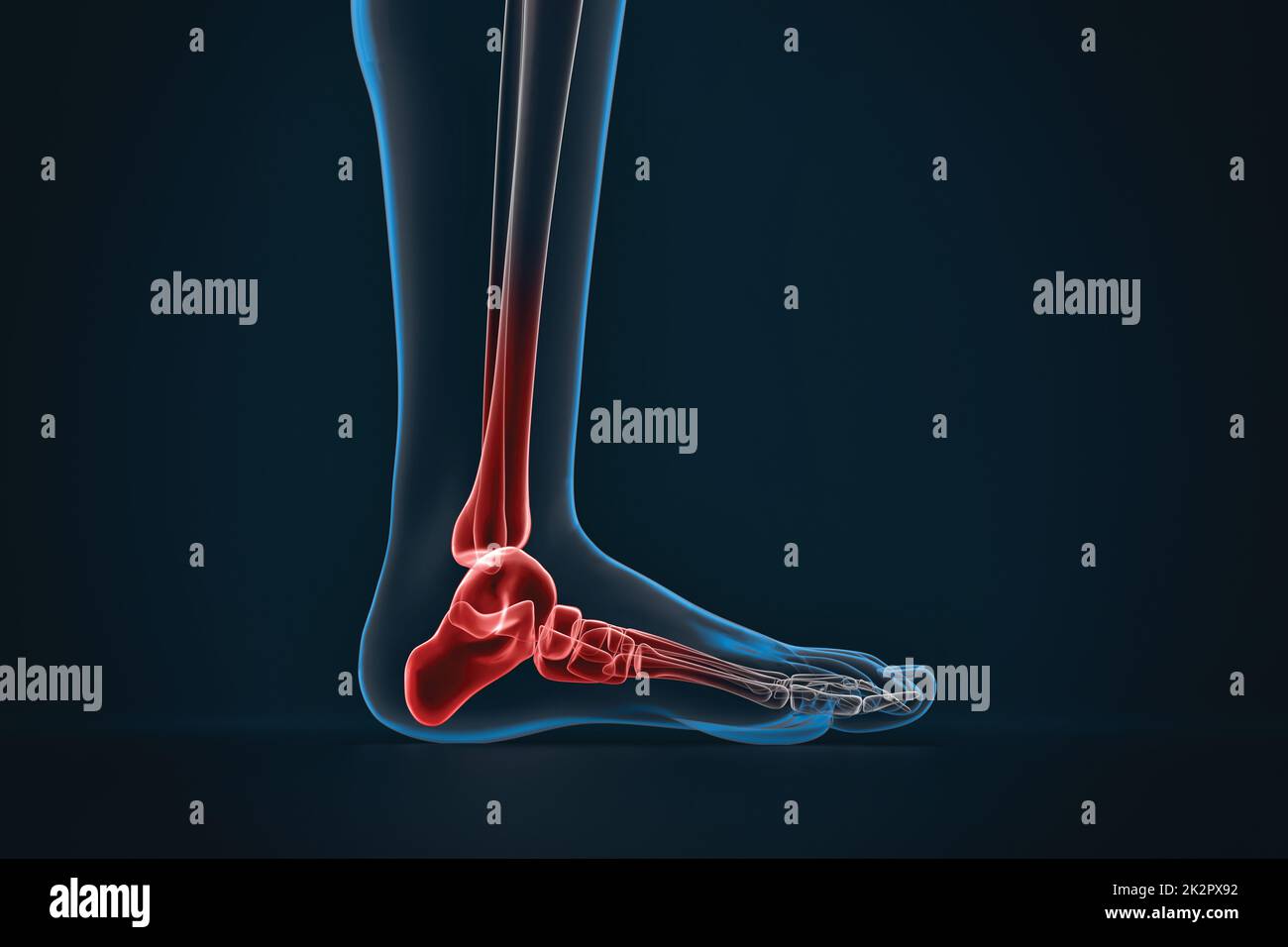 Arthritis des Knöchels. Röntgenaufnahme des Fußes. Seitenansicht Stockfoto