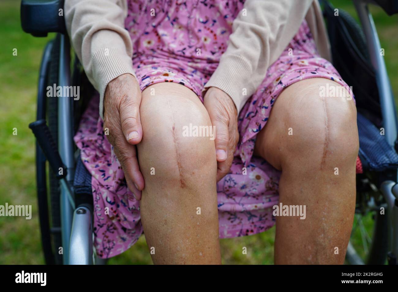 Asiatische ältere Frau Patientin mit Narbenersatz Knie-Operation im Krankenhaus. Stockfoto