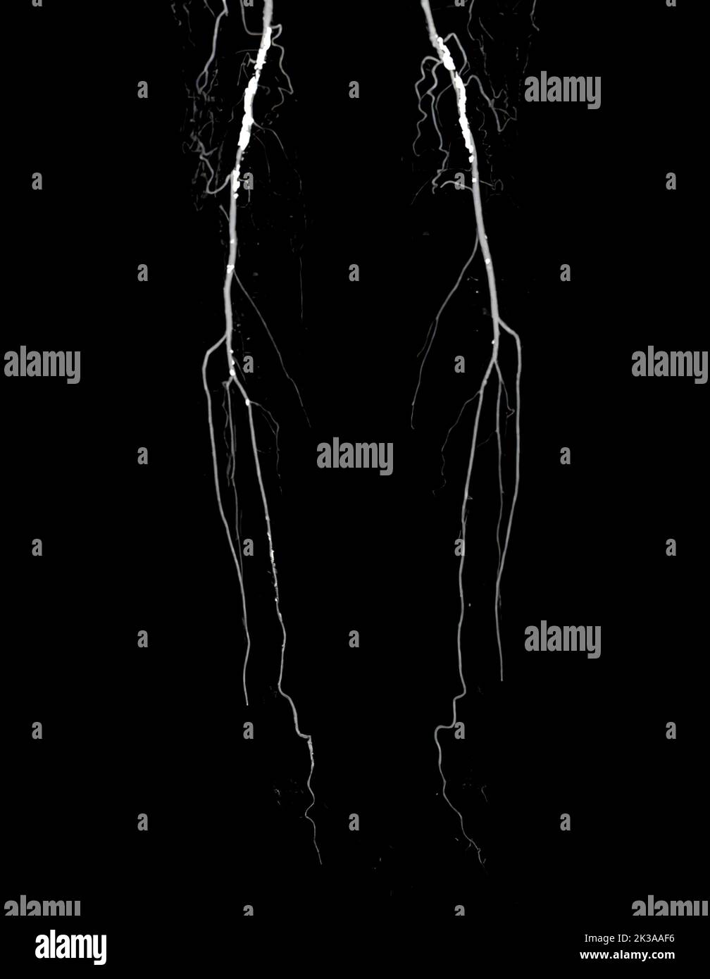CTA Femorale Arterie Verlaufende Bild Der Femoralen Arterie Mit Akuter