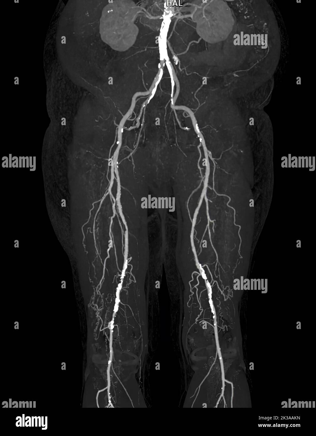 CTA Femorale Arterie Verlaufende Bild Der Femoralen Arterie Mit Akuter