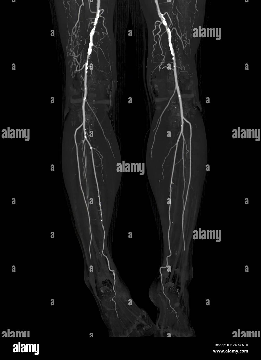 CTA Femorale Arterie Verlaufende Bild Der Femoralen Arterie Mit Akuter