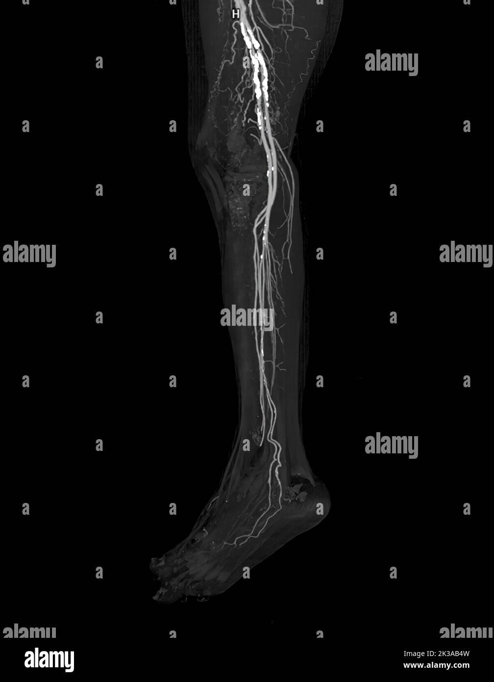 CTA Femorale Arterie Verlaufende Bild Der Femoralen Arterie Mit Akuter