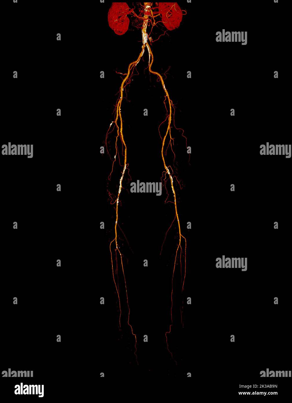 CTA femorale Arteria run off 3D zeigt ein Bild der femoralen Arteria mit akuter oder chronischer peripheraler arterieller Erkrankung. Stockfoto