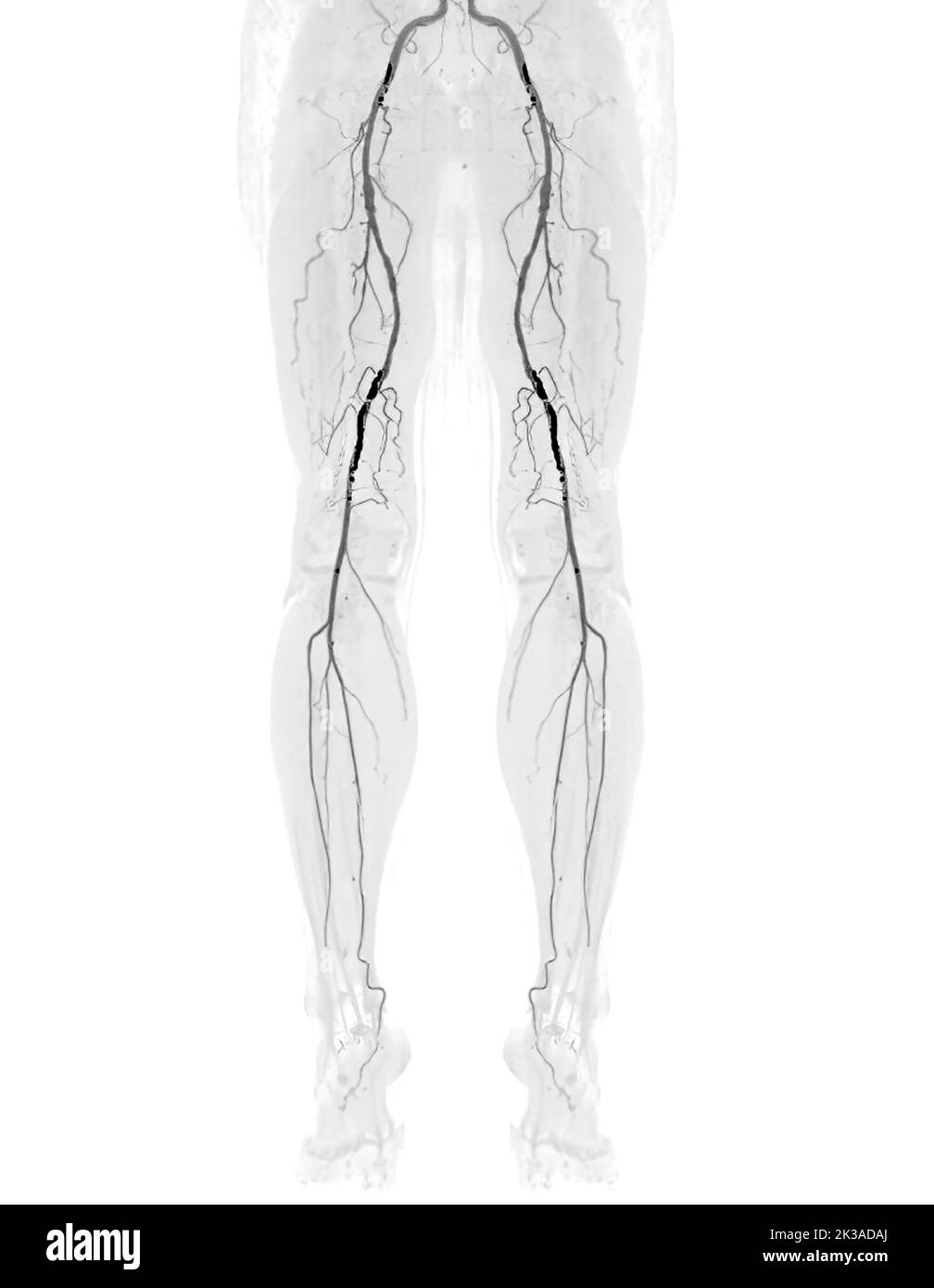 CTA Femorale Arterie Verlaufende Bild Der Femoralen Arterie Mit Akuter