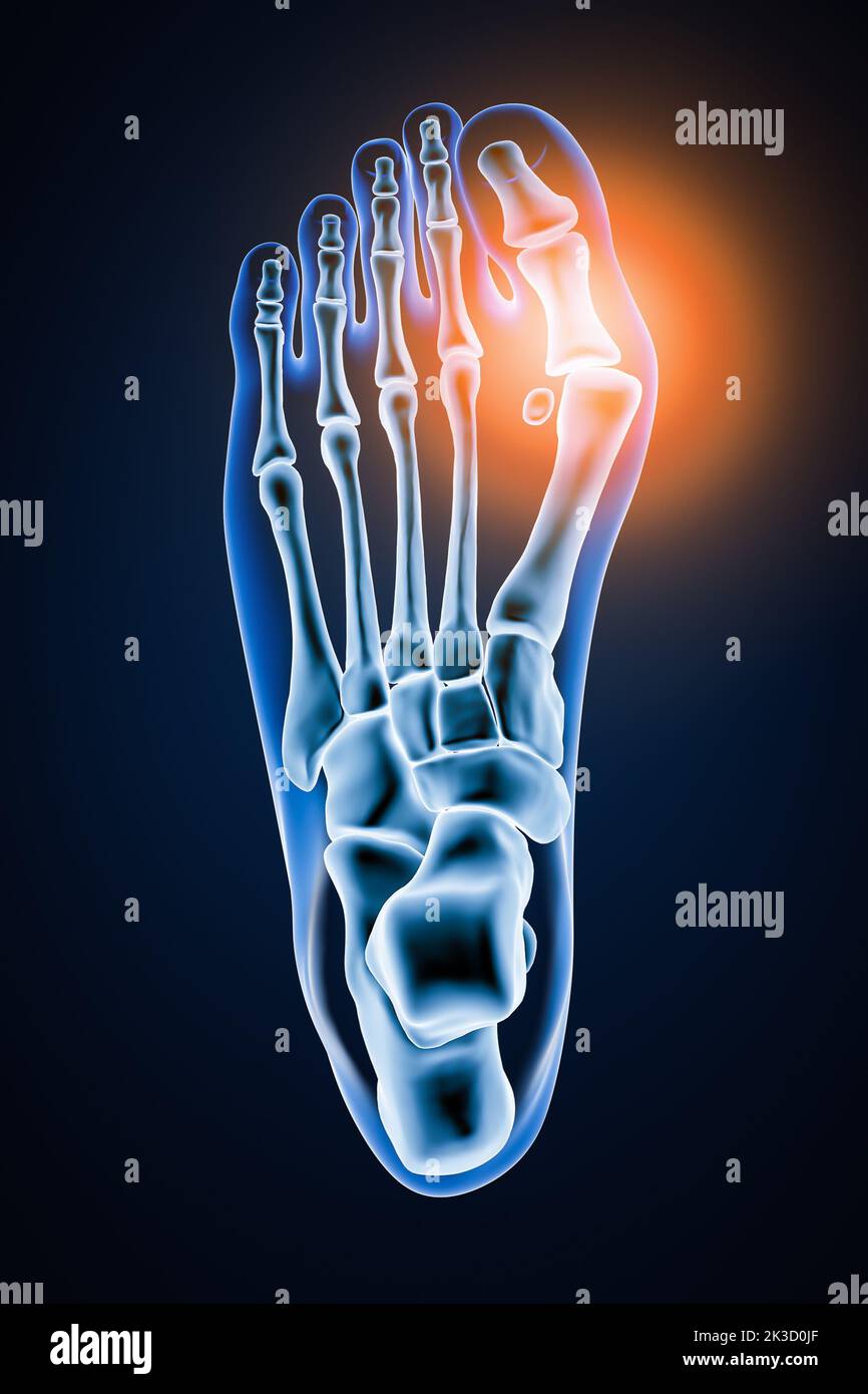 Hallux Valgus oder Bunion 3D Rendering Illustration. Überlegene oder dorsale Ansicht von präzisen menschlichen linken Fußknochen mit Körperkonturen auf blauem Hintergrund. Ein Stockfoto