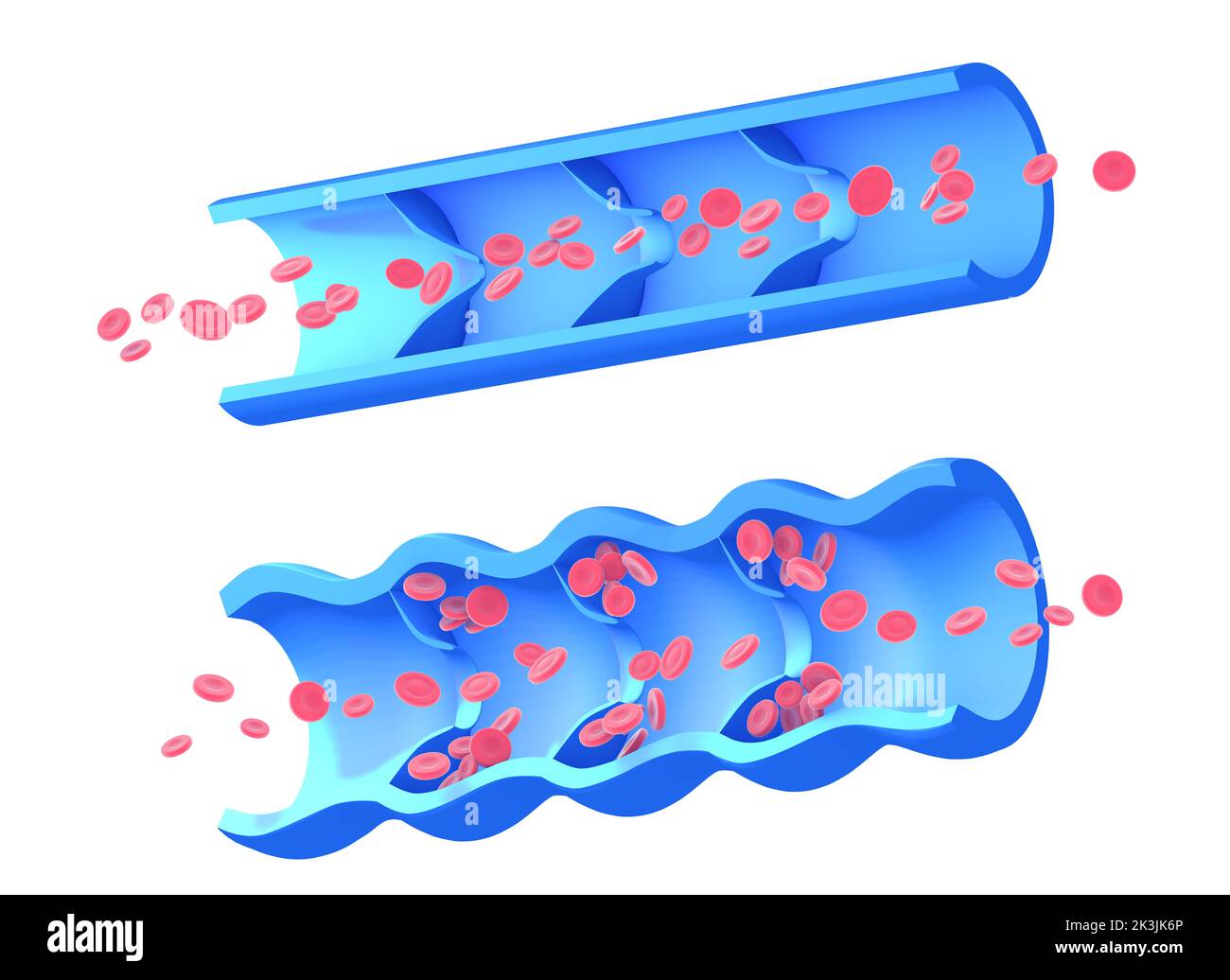 Anatomische 3D Abbildung von zwei Bildern, erkrankte inkompetente Vene und gesunde Vene. Grafische Darstellung des Blutkreislaufs. Stockfoto