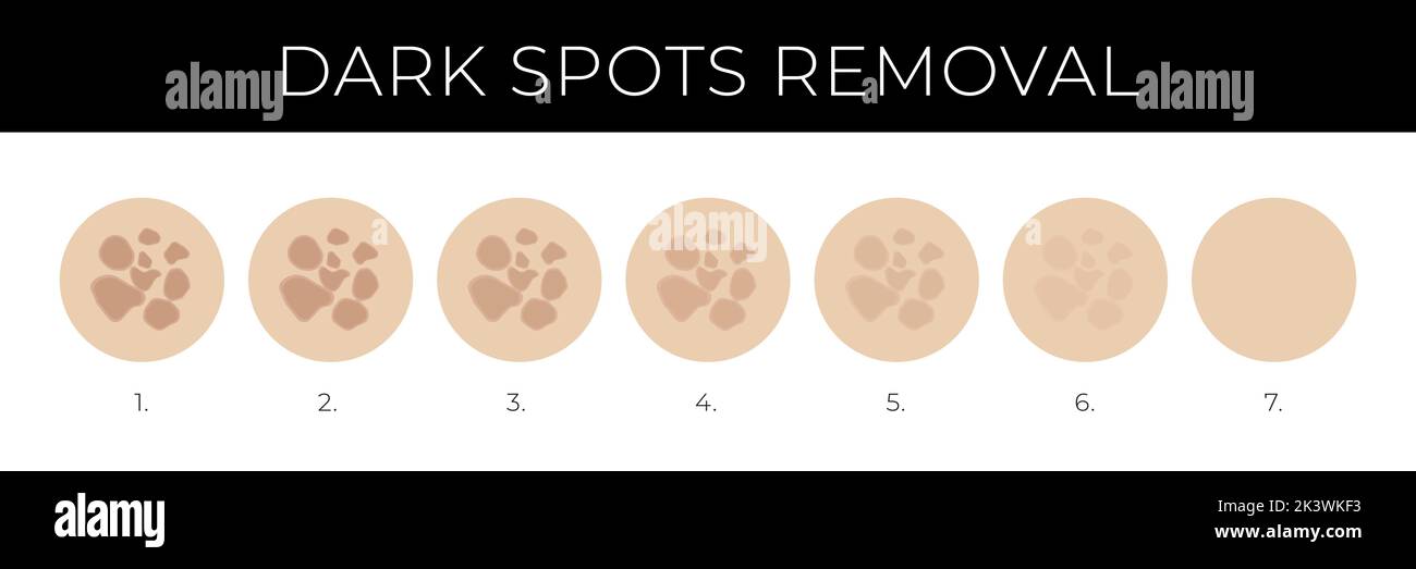 Abbildung zur Entfernung dunkler Flecken mit Melasma-Ausblendstufen Stock Vektor