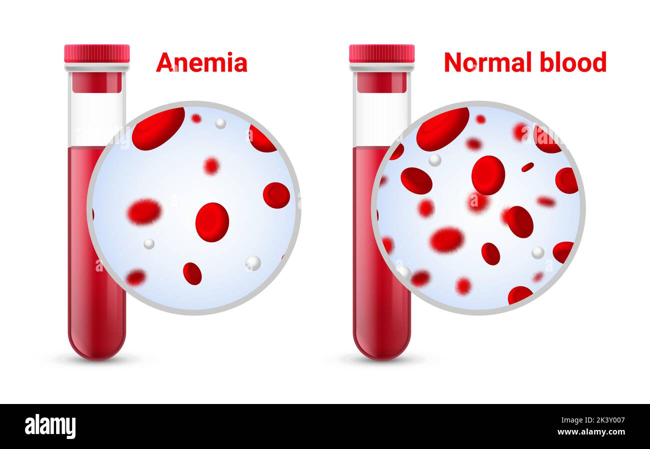 Anämie Problem Kreislauf Eisen Körper Diagramm Hintergrund. Anämiebiologie Blut isoliert medizinisch normal Symbol. Stock Vektor