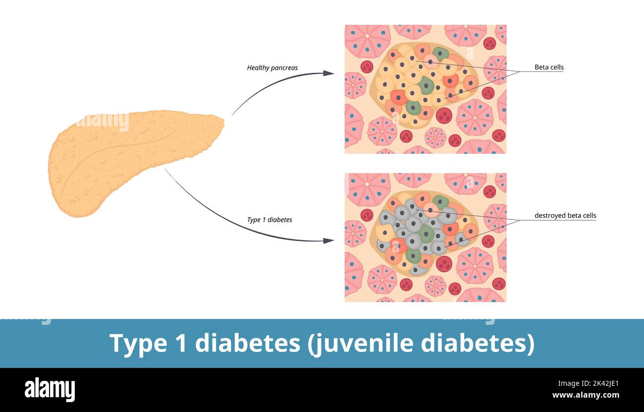 Typ-1-Diabetes (Jugenddiabetes). Der Diabetes mellitus Typ 1 entsteht, wenn die Betazellen der Bauchspeicheldrüse zerstört werden. Zerstörte β-Zellen in der Bauchspeicheldrüse Stock Vektor