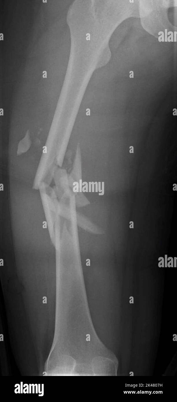 Gebrochener Oberschenkel, Röntgenaufnahme Stockfoto