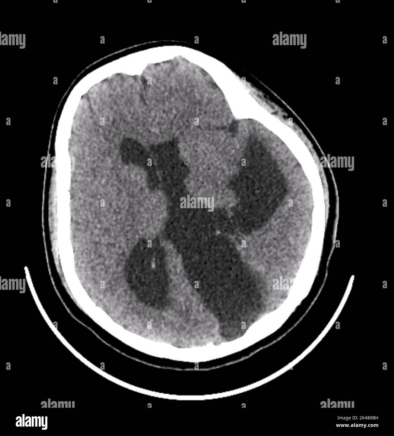 Schizenzephaly-Hirndeformität, CT-Scan Stockfoto