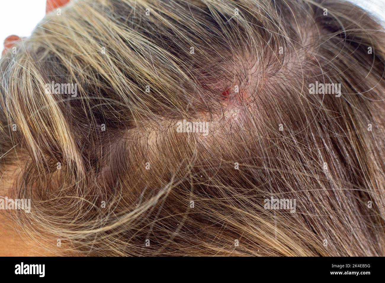 Fossa pilonidale Fotos und Bildmaterial in hoher Auflösung Alamy