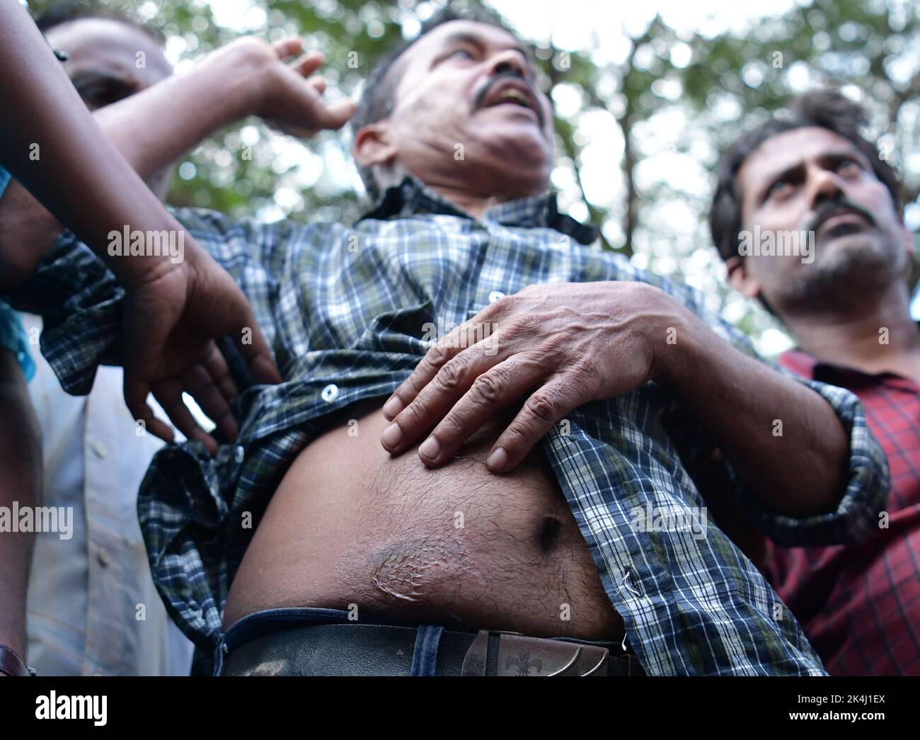 Ein Lehrer, der von seiner Arbeit gekündigt wurde, zeigt seine Wunde, nachdem er von einer Tränengashülle nach einem Handgemenge mit der Polizei auf einem Protestgelände in Agartala getroffen wurde. Tripura, Indien. Stockfoto