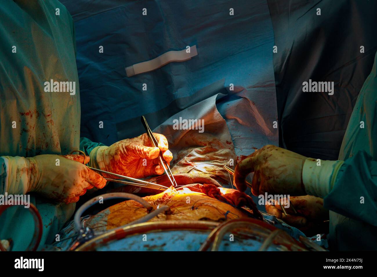 Koronarararterie-Bypass-Transplantat-CABG für Herzoperationen aufgrund einer koronaren Herzkrankheit Stockfoto