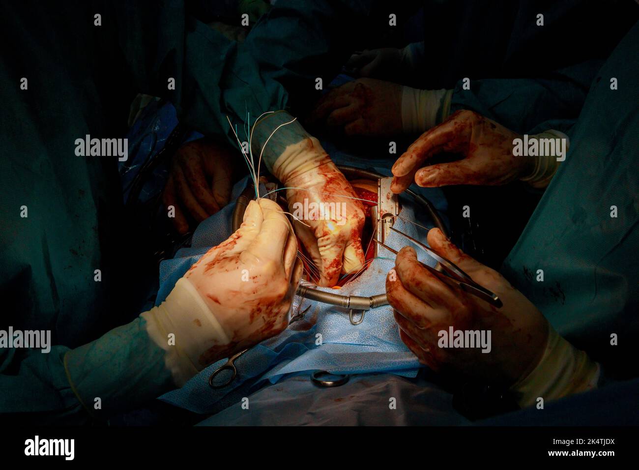 Das CABG-Verfahren für Koronarararterien-Bypass-Transplantate wird für Herzoperationen aufgrund einer koronaren Herzerkrankung im Operationssaal des Krankenhauses durchgeführt Stockfoto