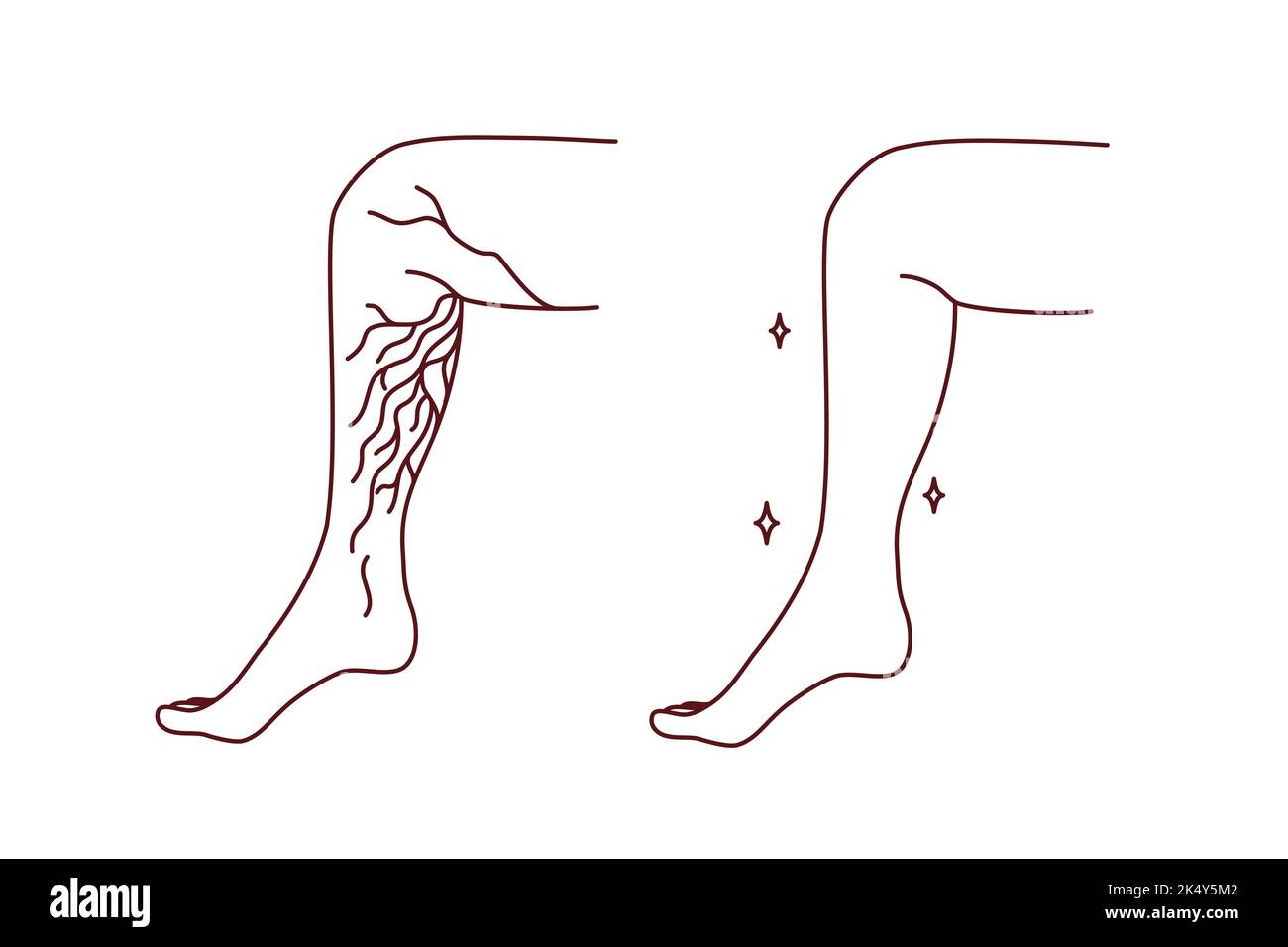 Nahaufnahme von ungesunden und gesunden Beinen mit Krampfadern. Der Patient leidet an Varikosen. Gesundheitswesen und Medizin. Vektorgrafik. Stock Vektor