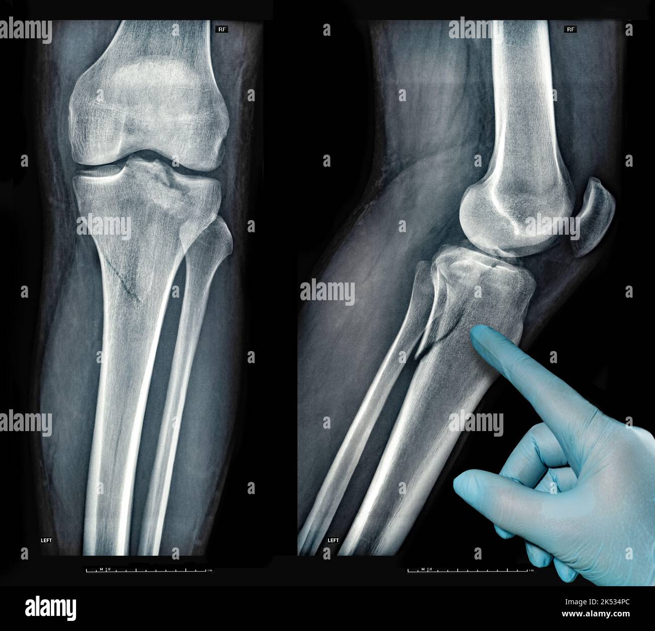 Röntgenbilder zeigen eine echte Fraktur des gebrochenen Beinknochens unter dem Knie nach einer Verletzung Stockfoto