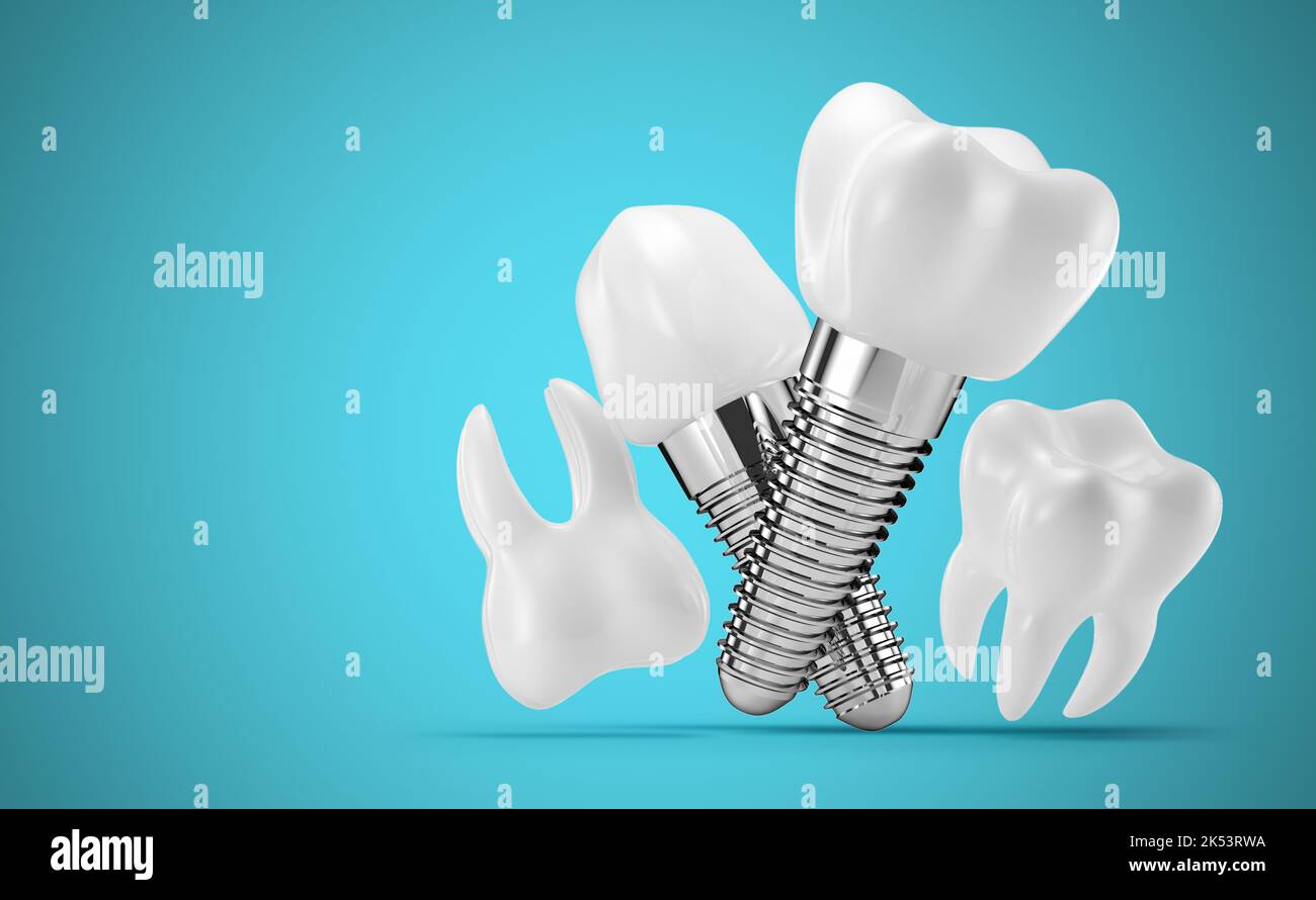 Zahnimplantate auf blauem Hintergrund. 3D Rendering, 3D Illustration. Stockfoto