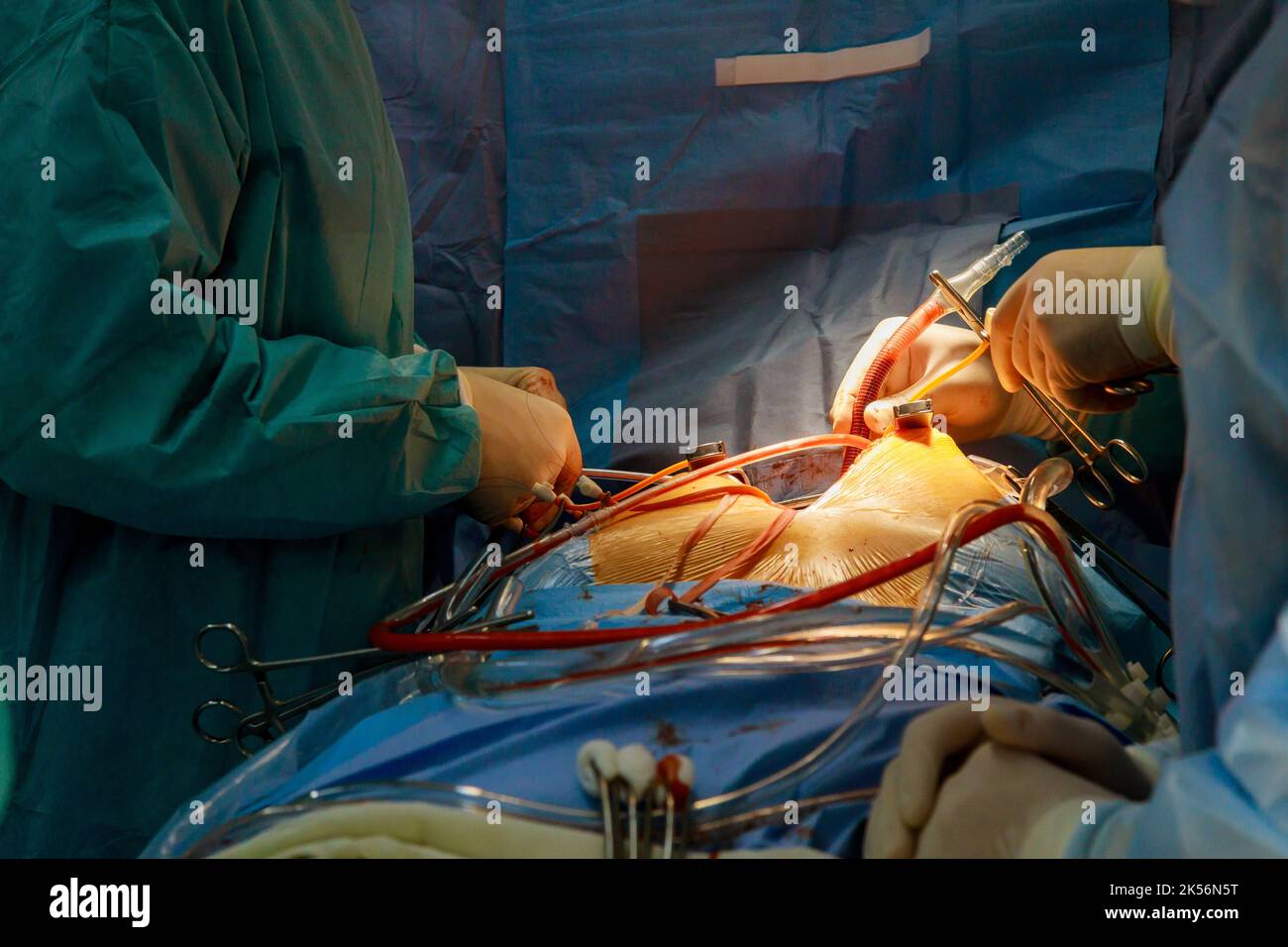 Im Operationssaal eines Krankenhauses wird für Herzoperationen, die durch eine koronare Herzkrankheit verursacht werden, ein Koronarararterien-Bypass-Transplantat-CABG durchgeführt Stockfoto