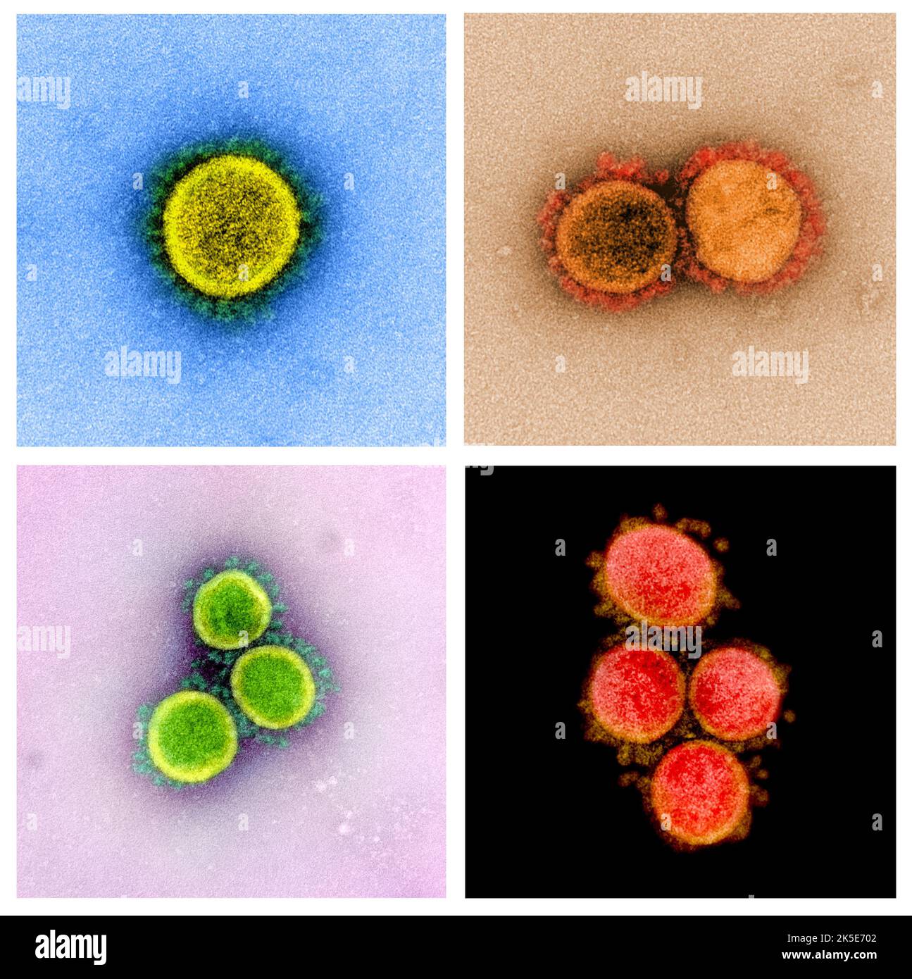 Eine Zusammenstellung von Bildern des neuartigen Coronavirus SARS-CoV-2. Transmissions-Elektronenmikrographie eines SARS-CoV-2-Virus-Partikels, isoliert von einem Patienten. Eine optimierte und verbesserte, einzigartige Composite-Version von vier Rasterelektronenmikrographen-Bildern, Quelle: NIAID Stockfoto