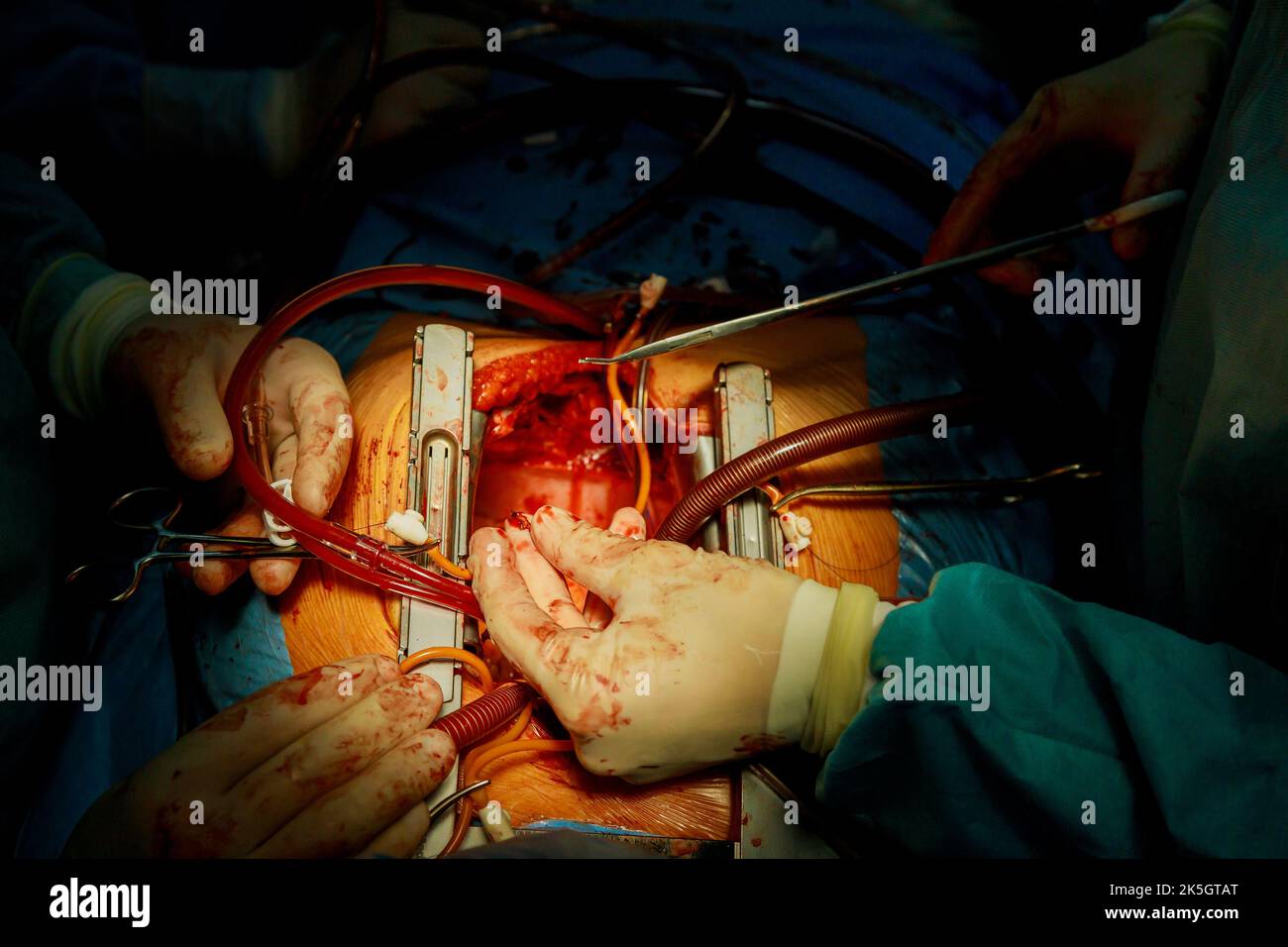 Aufgrund einer Fehlfunktion der Herzklappe ist eine Operation am offenen Herzen während des Verfahrens erforderlich, um die Herzklappe im Operationssaal auszutauschen Stockfoto