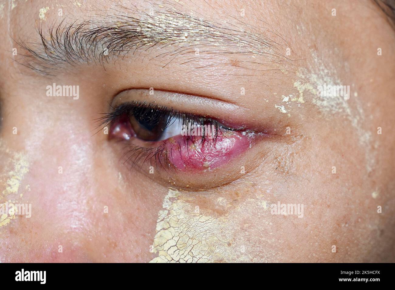 Geschwollenes unteres Augenlid der jungen asiatischen Frau. Sie kann durch Blepharitis, Sties, Allergien oder Chalazion verursacht werden. Stockfoto