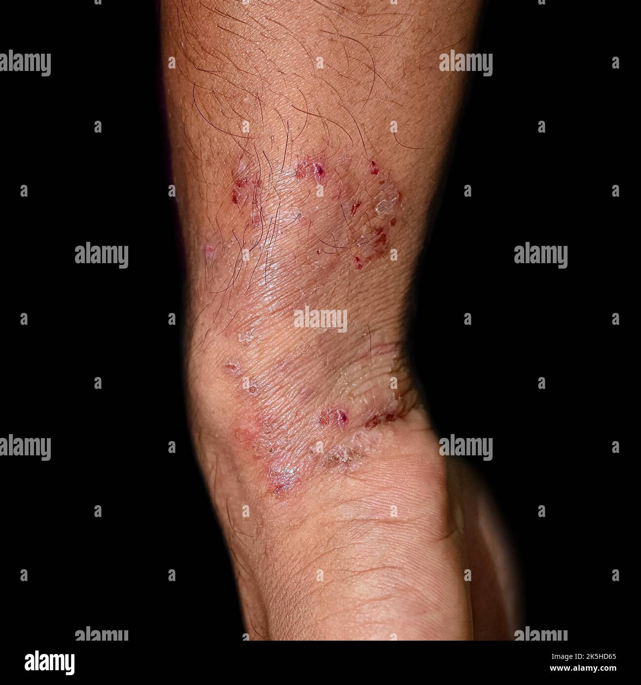 Pilzinfektion namens Tinea corporis im Unterarm des südostasiatischen Mannes. Stockfoto