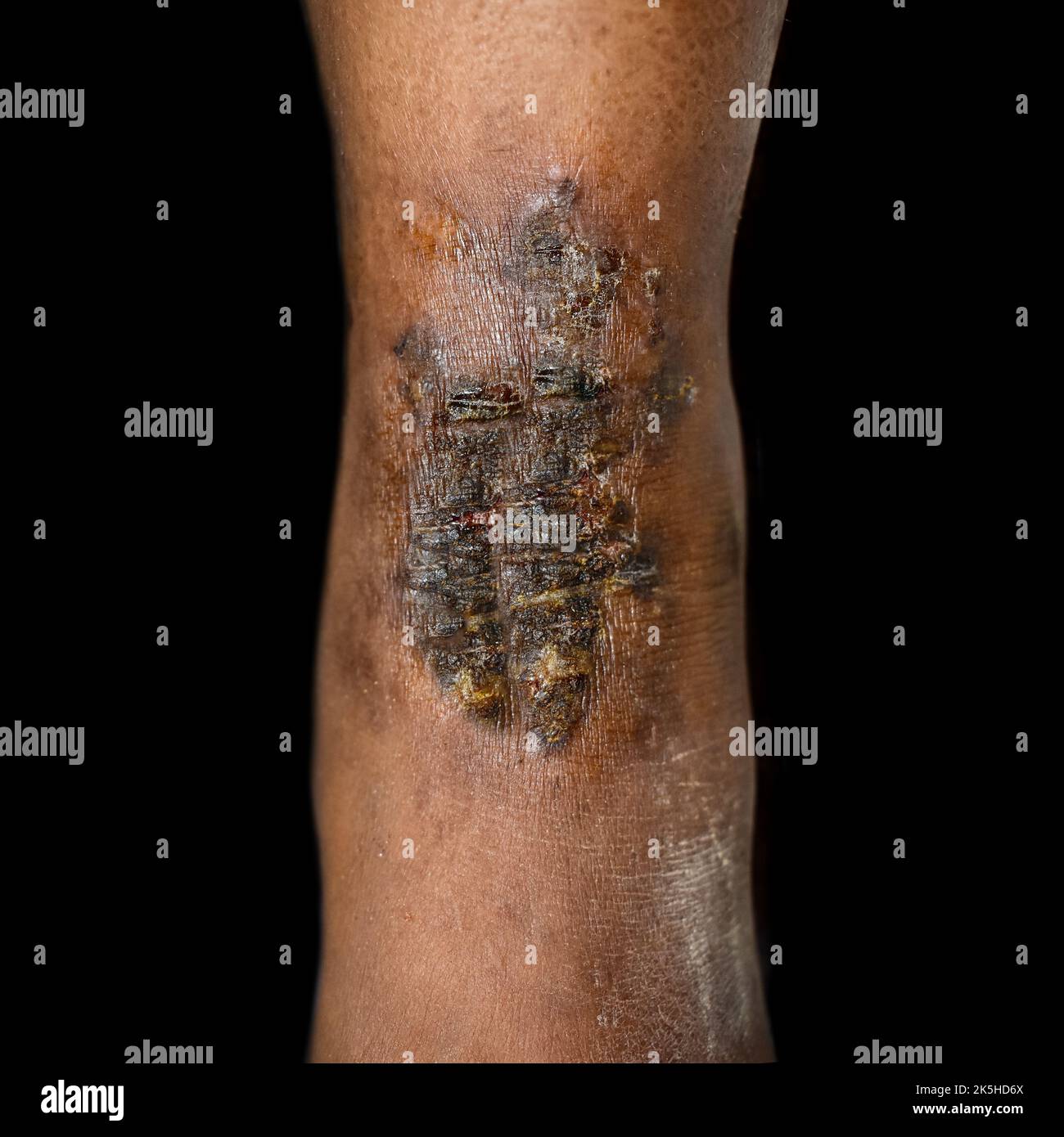 Ekzem oder Kontaktdermatitis im Fuß der südostasiatischen Frau. Stockfoto