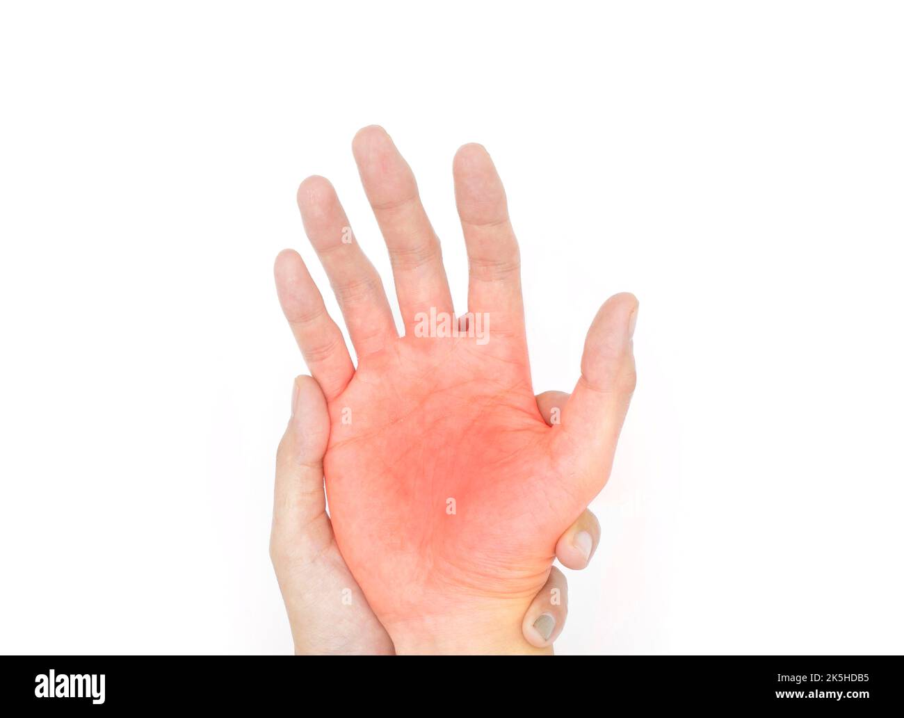 Schmerzhafter Palmar-Aspekt des asiatischen jungen Mannes. Konzept des Kompartiment-Syndroms, Zellulitis und Schmerzen der Handmuskulatur. Stockfoto