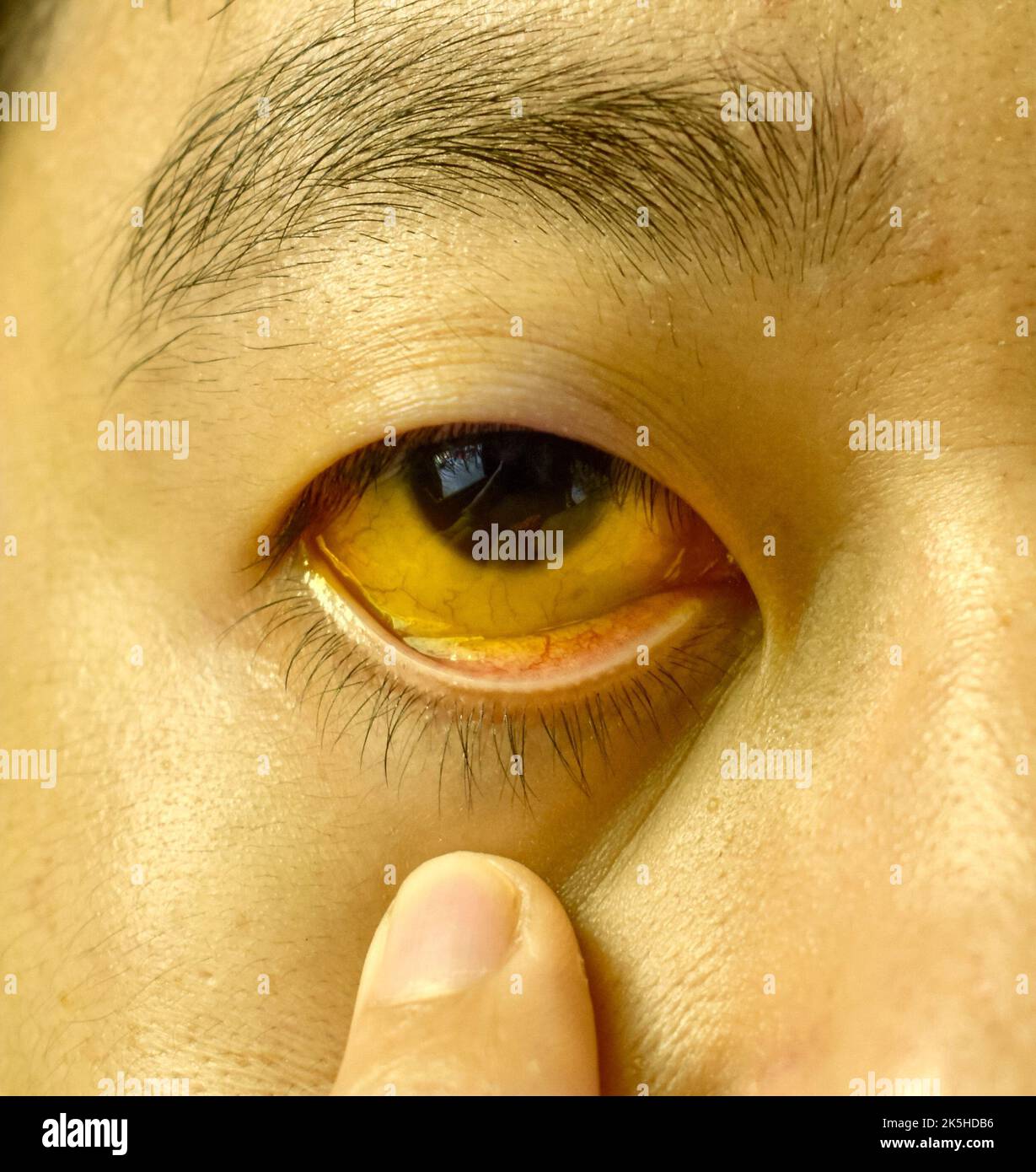 Bei einem männlichen asiatischen Patienten ist die Augenauge sehr stark. Gelbliche Verfärbung von Haut und Sklera. Hyperbilirubinämie. Akute Hepatitis. Stockfoto