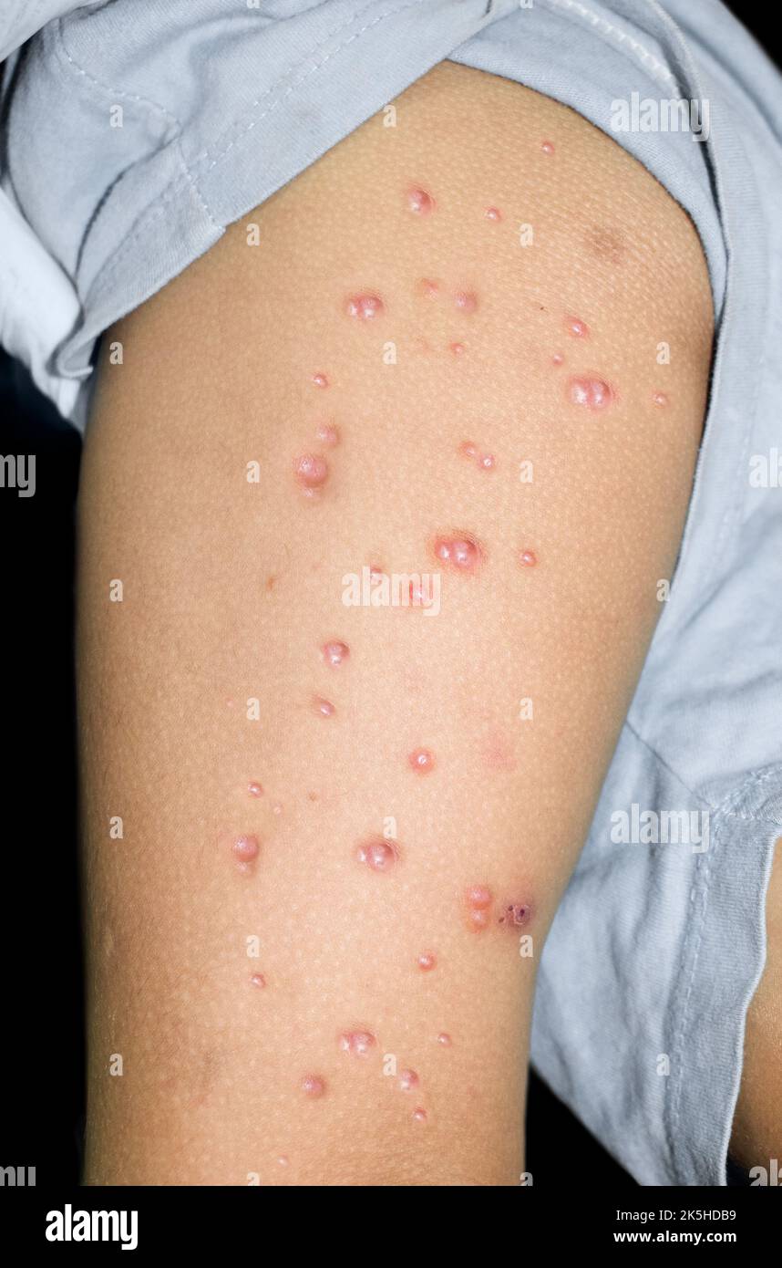Monkeypox-Läsionen im Oberschenkel des asiatischen, burmesischen Kindes. Stockfoto